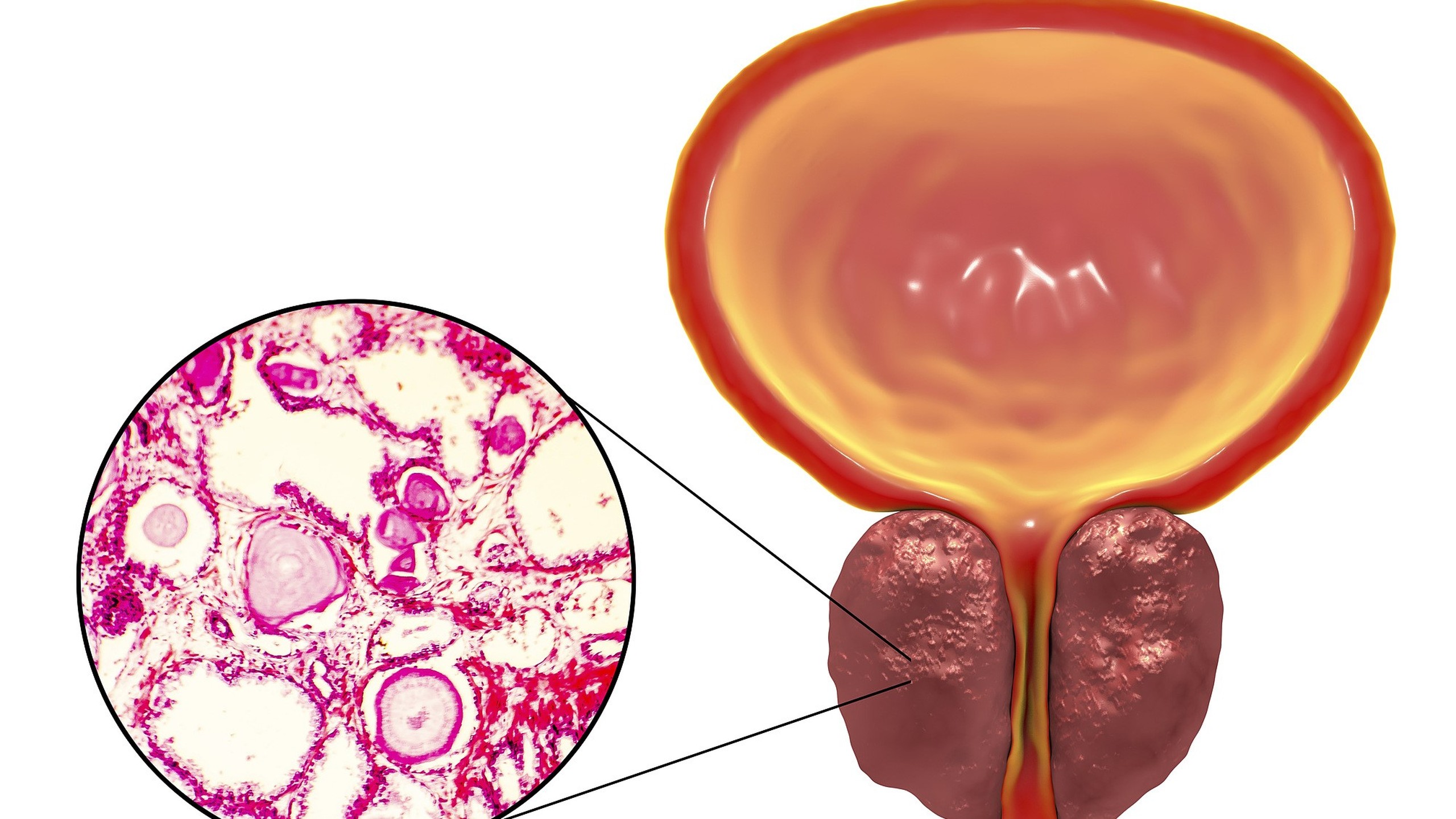 Nang tuyến tiền liệt: Nguyên nhân và biện pháp chăm sóc người bệnh