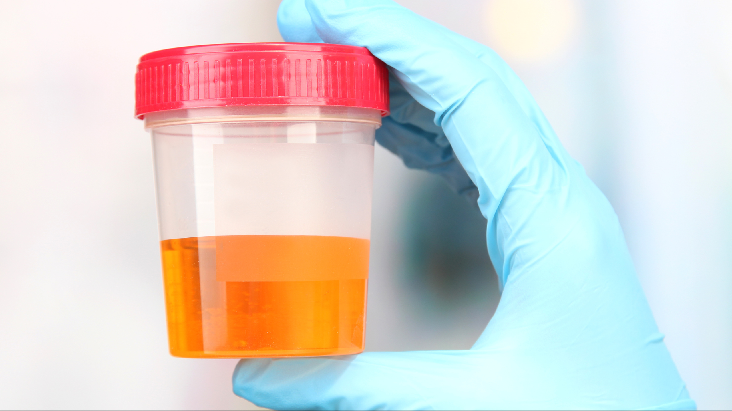 Nước tiểu màu đỏ là gì? Nguyên nhân và cách điều trị