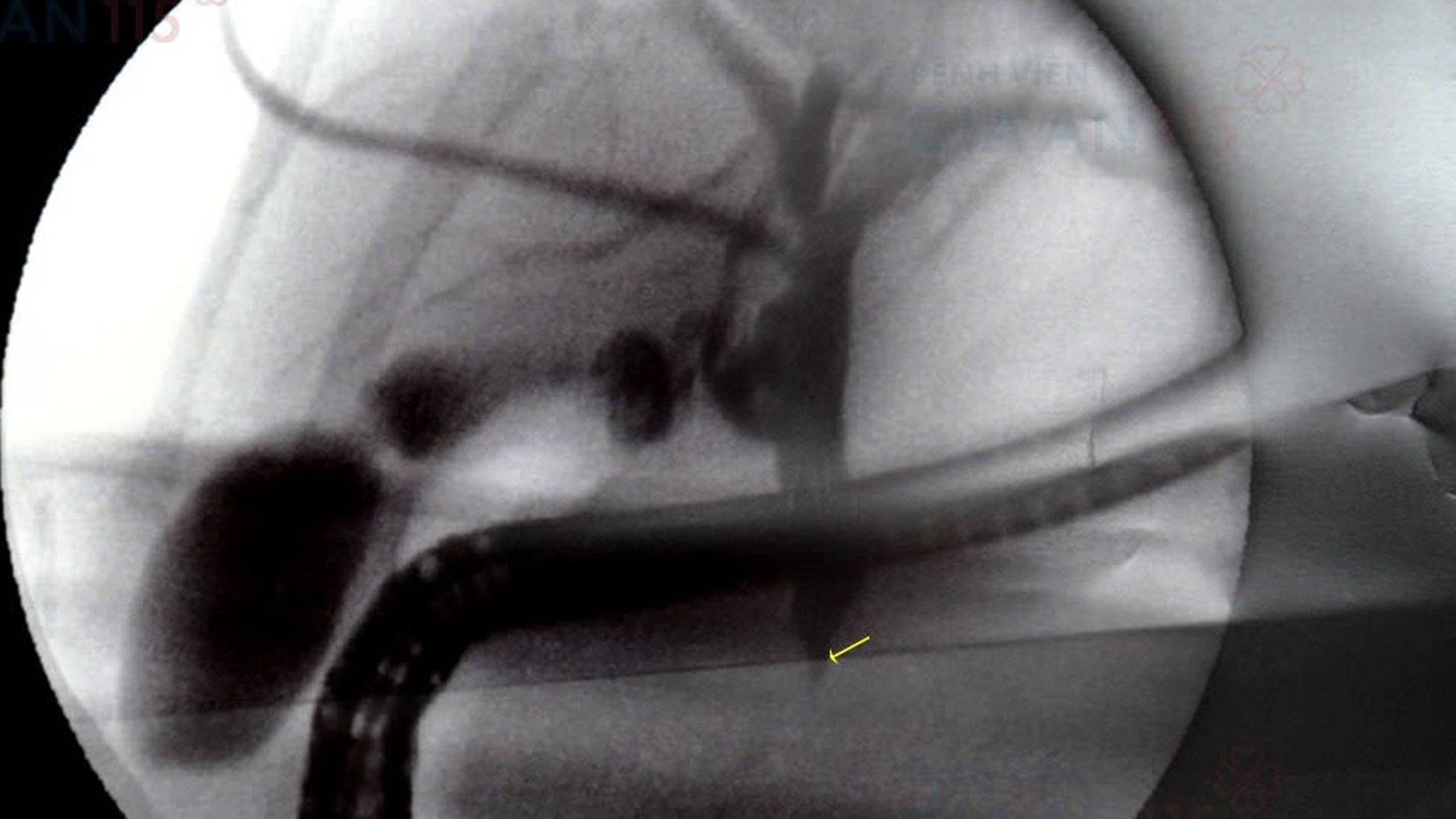 PTBD đường mật​ là gì và một số thông tin cần biết về PTBD đường mật 0