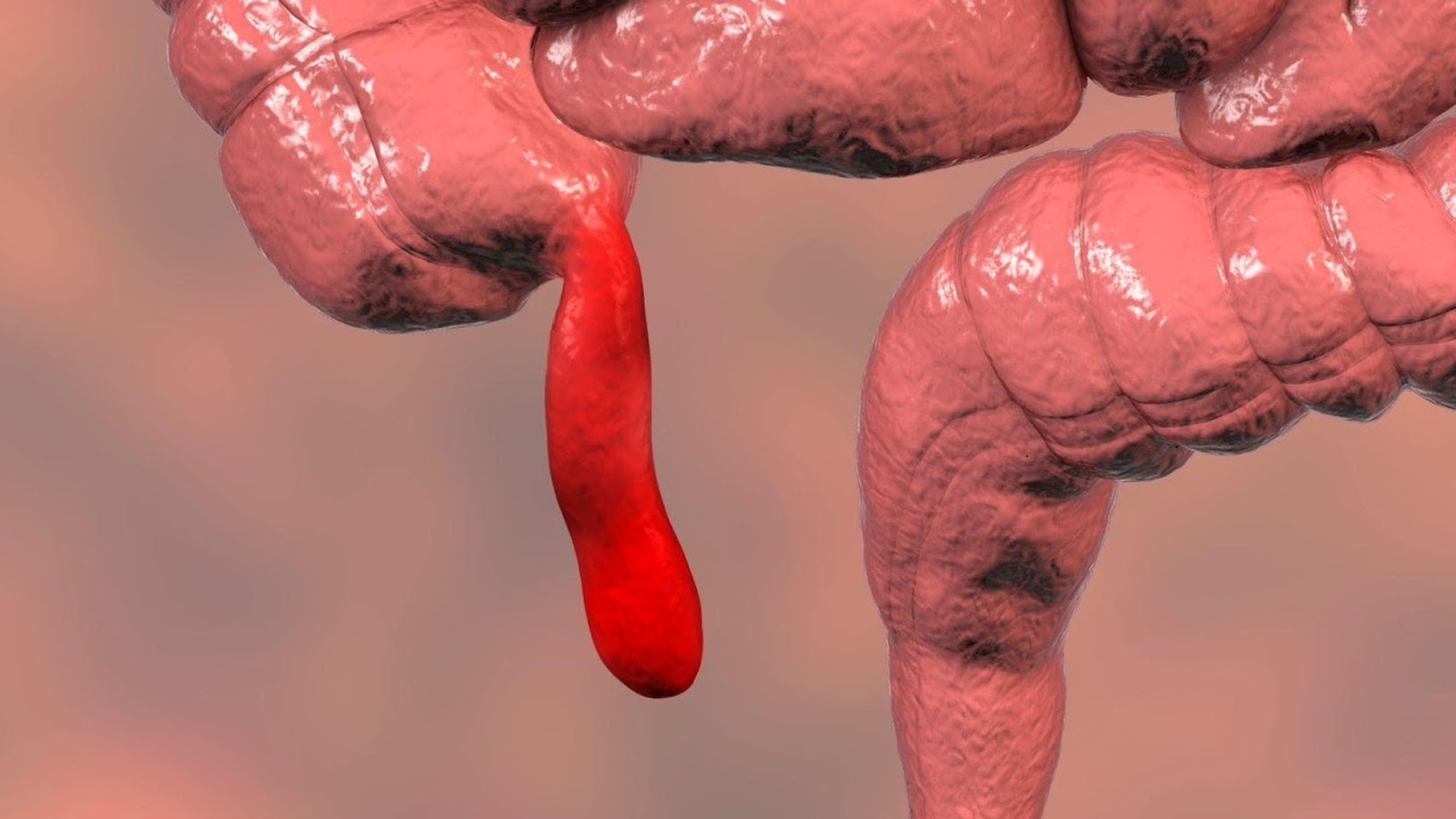 Ruột thừa đau bên nào? Triệu chứng, nguyên nhân và cách phòng tránh hiệu quả 0