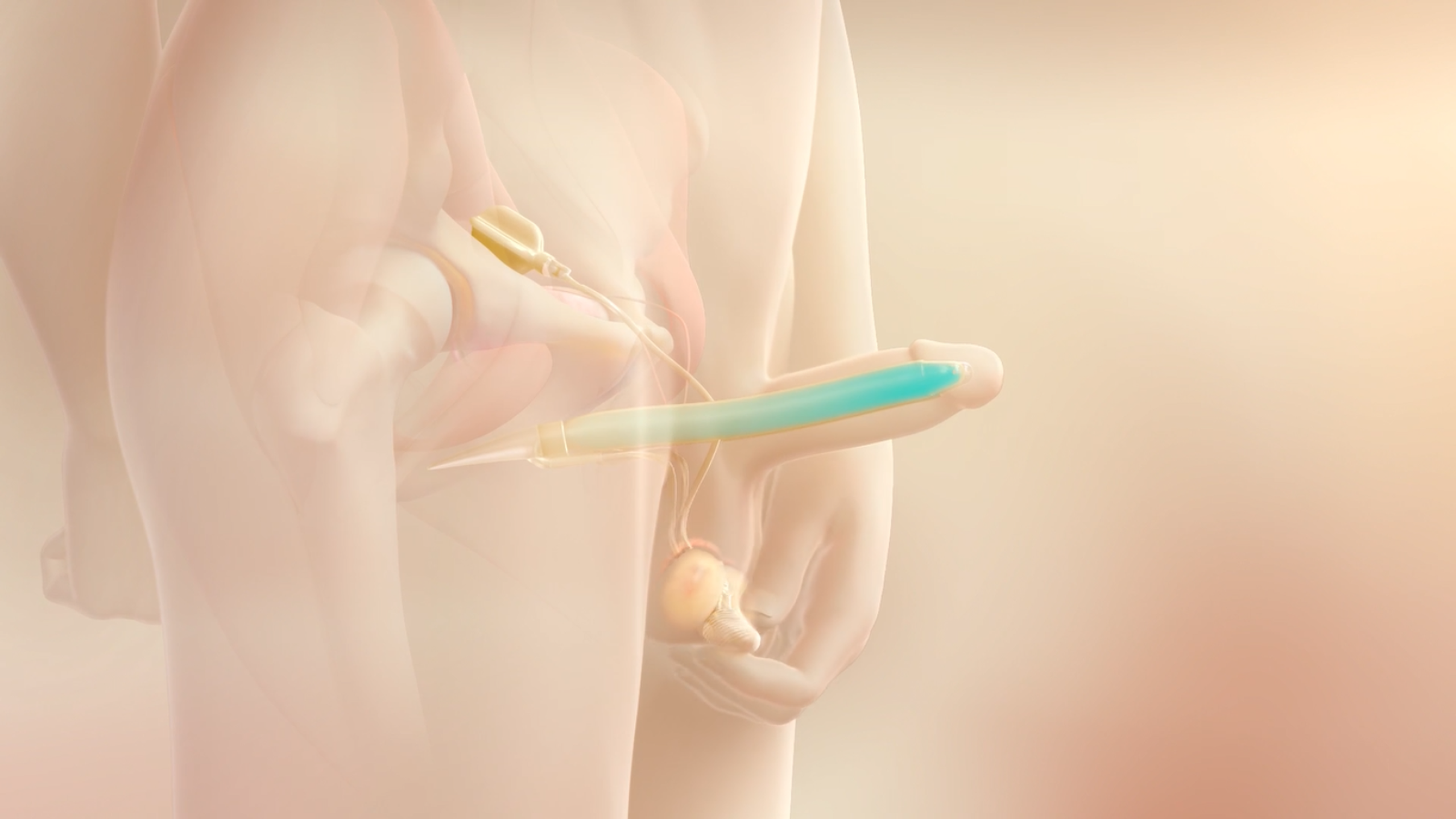 Thể hang nhân tạo: Ứng dụng trong điều trị rối loạn cương dương