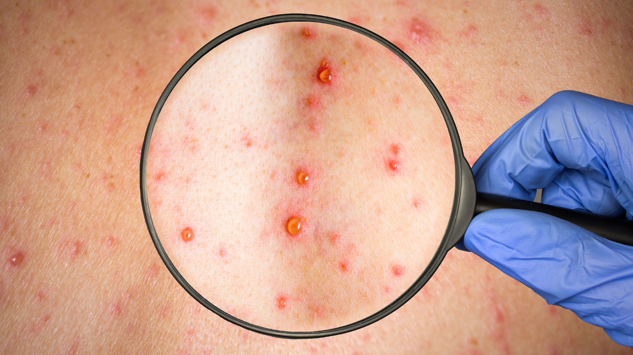 Thủy đậu và Rubella: Những khác biệt quan trọng cần biết