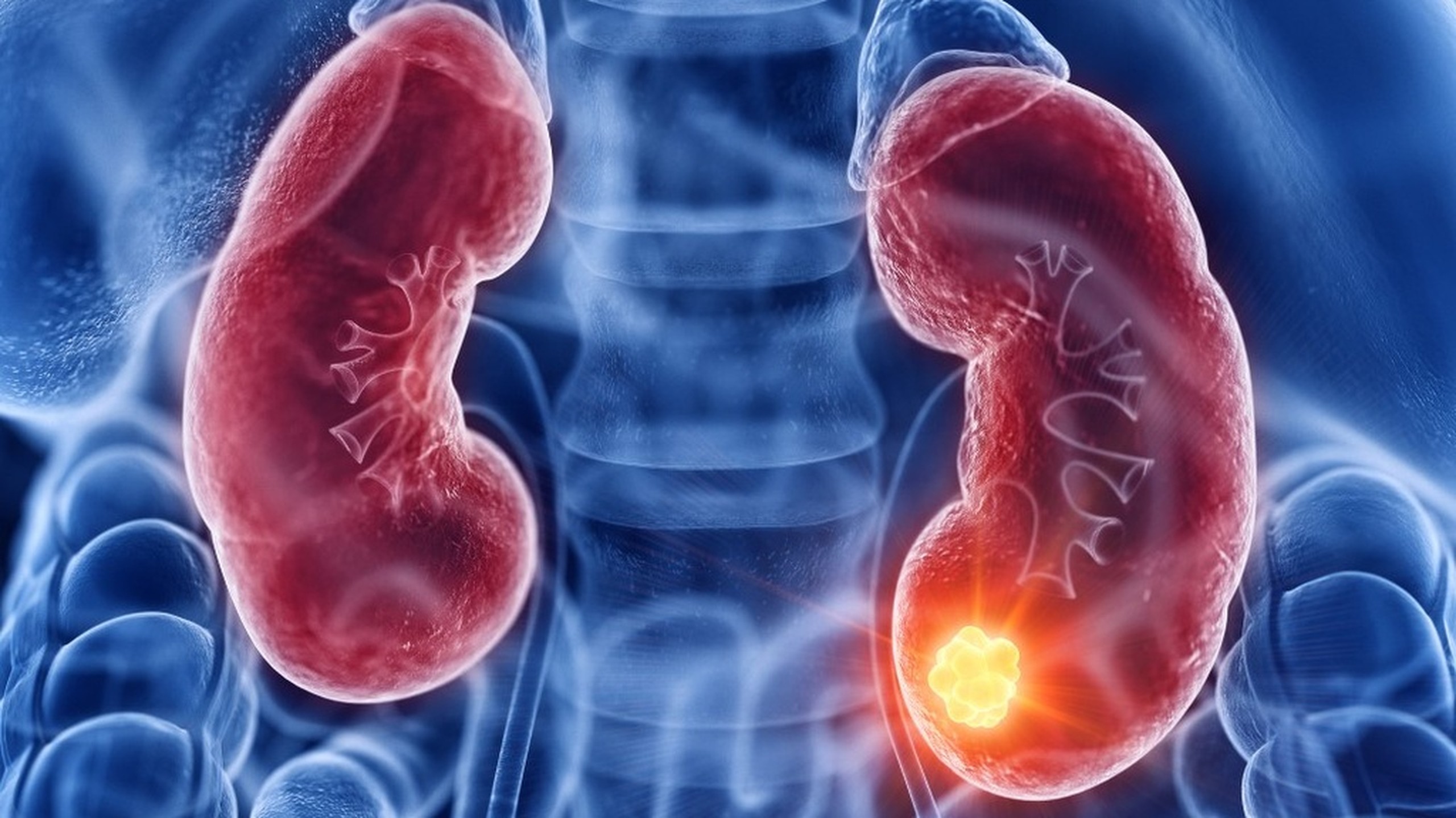 Tiên lượng ung thư thận: Những điều cần biết để chuẩn bị tốt hơn