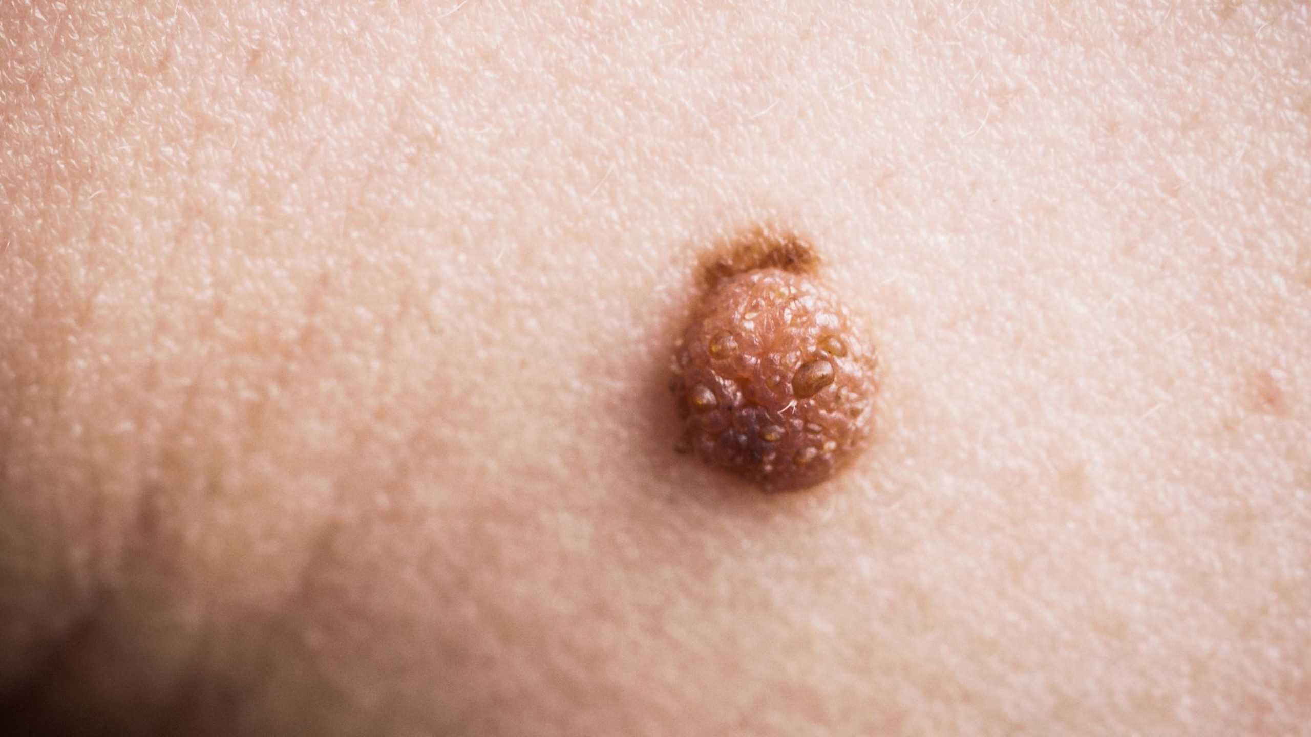 U nhú lành tính là gì? Phân loại và cách xử lý hiệu quả 1