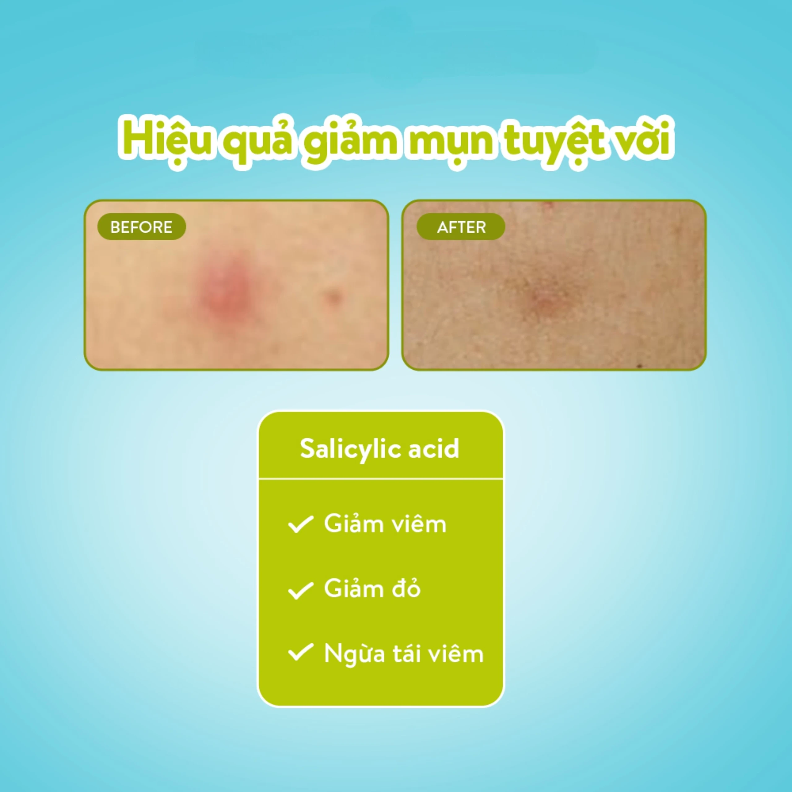 Miếng dán mụn ban ngày Derma Angel Plus (12 miếng) hút dịch mủ, làm lành vết thương nhanh chóng