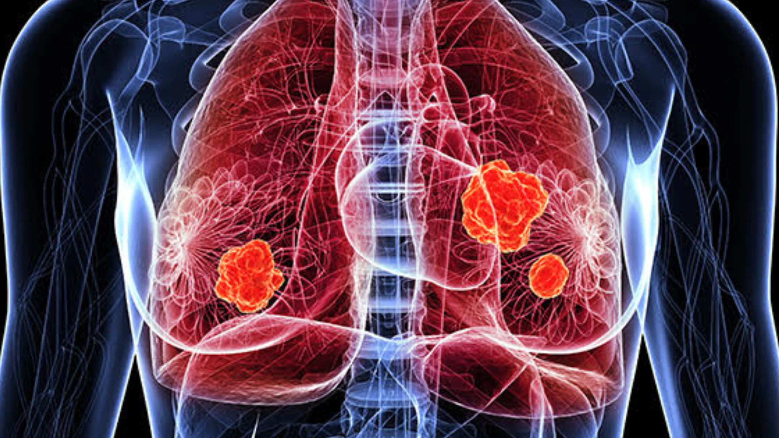 11 dấu hiệu ung thư phổi giai đoạn đầu là gì? Làm sao để phòng ngừa ung thư phổi hiệu quả?