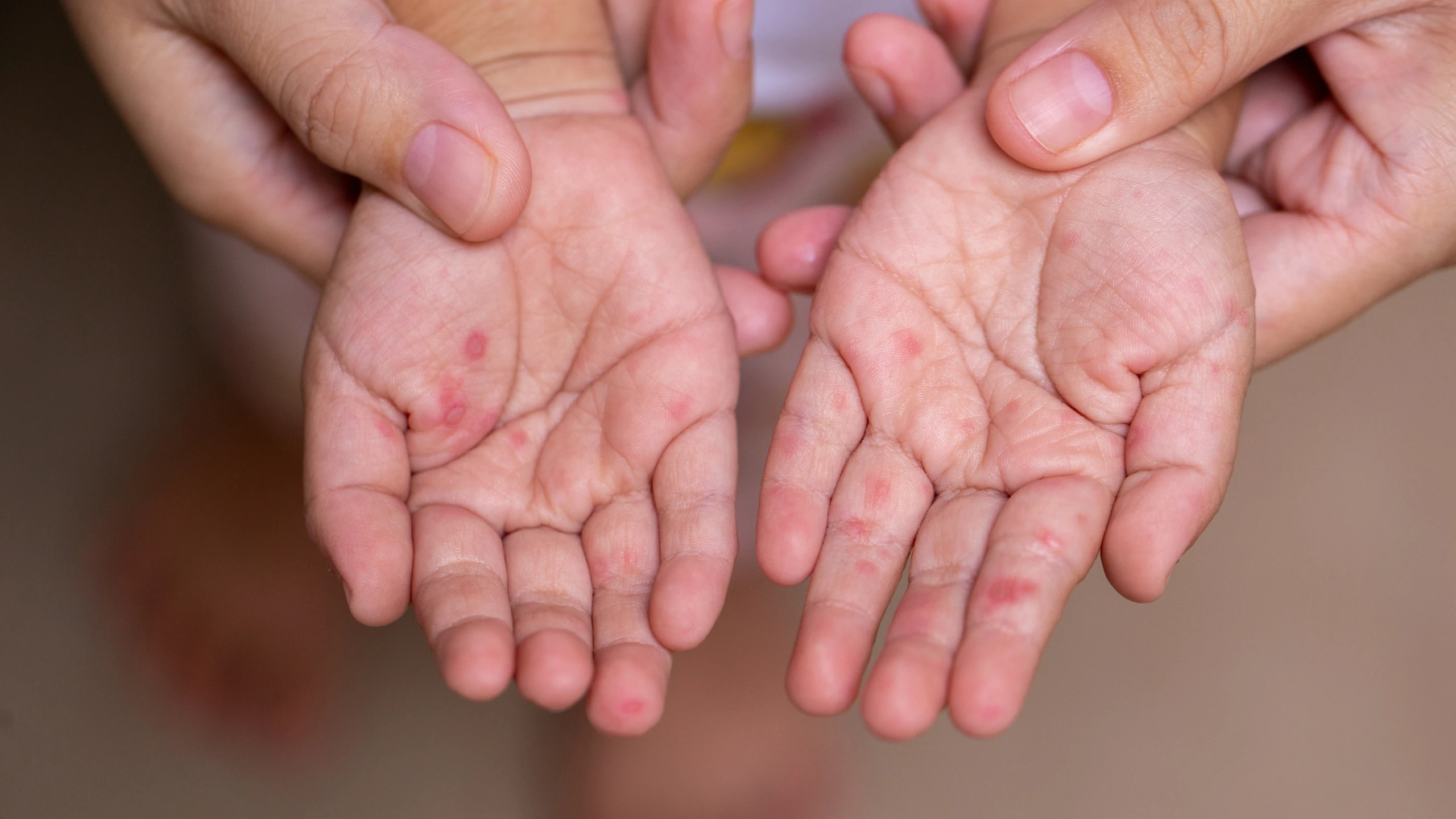 5 loại thuốc cần có khi trẻ bị tay chân miệng mà phụ huynh nên biết