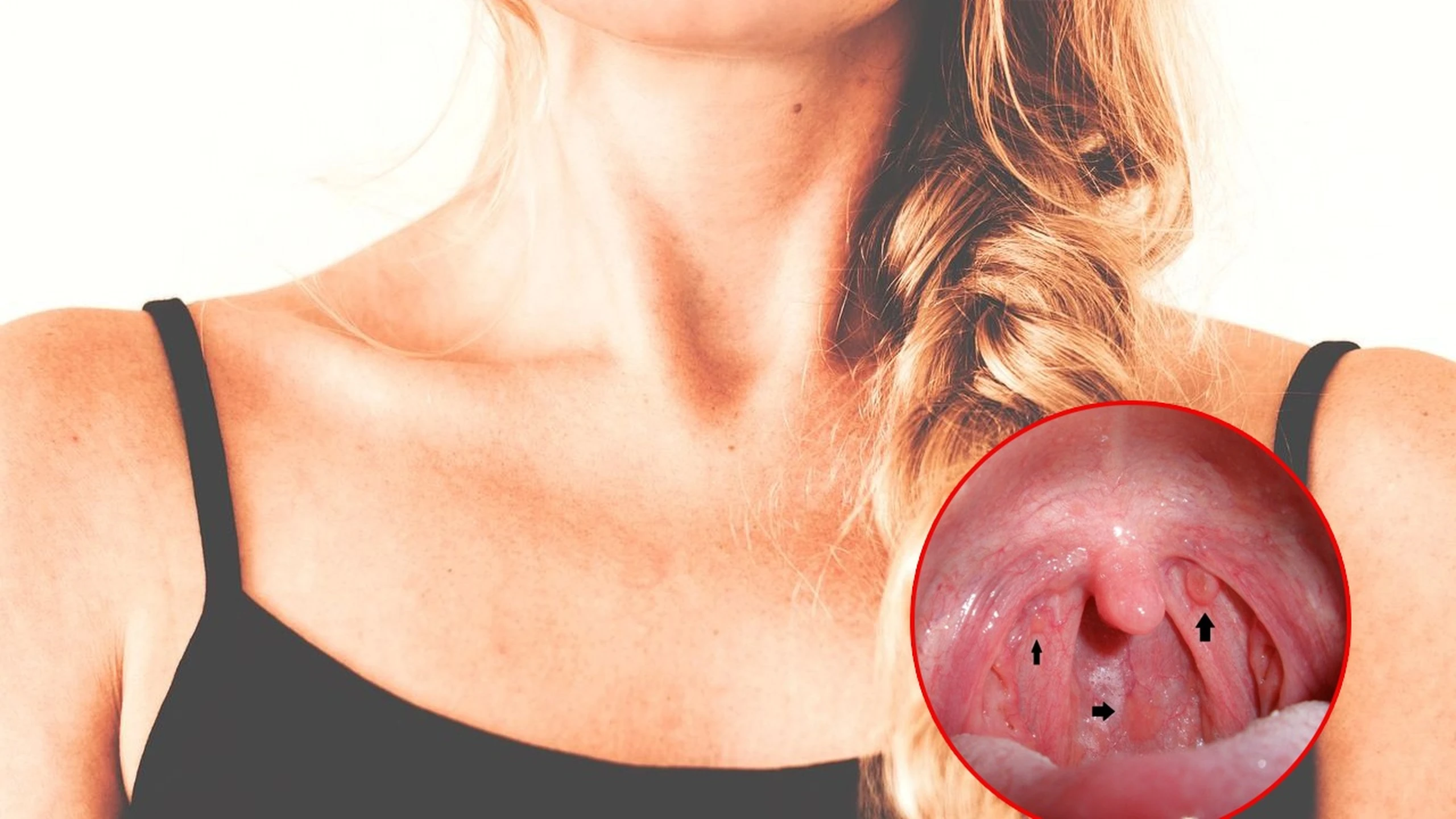 Ung thư vòm họng giai đoạn 3 có chữa được không? Các phương pháp điều trị