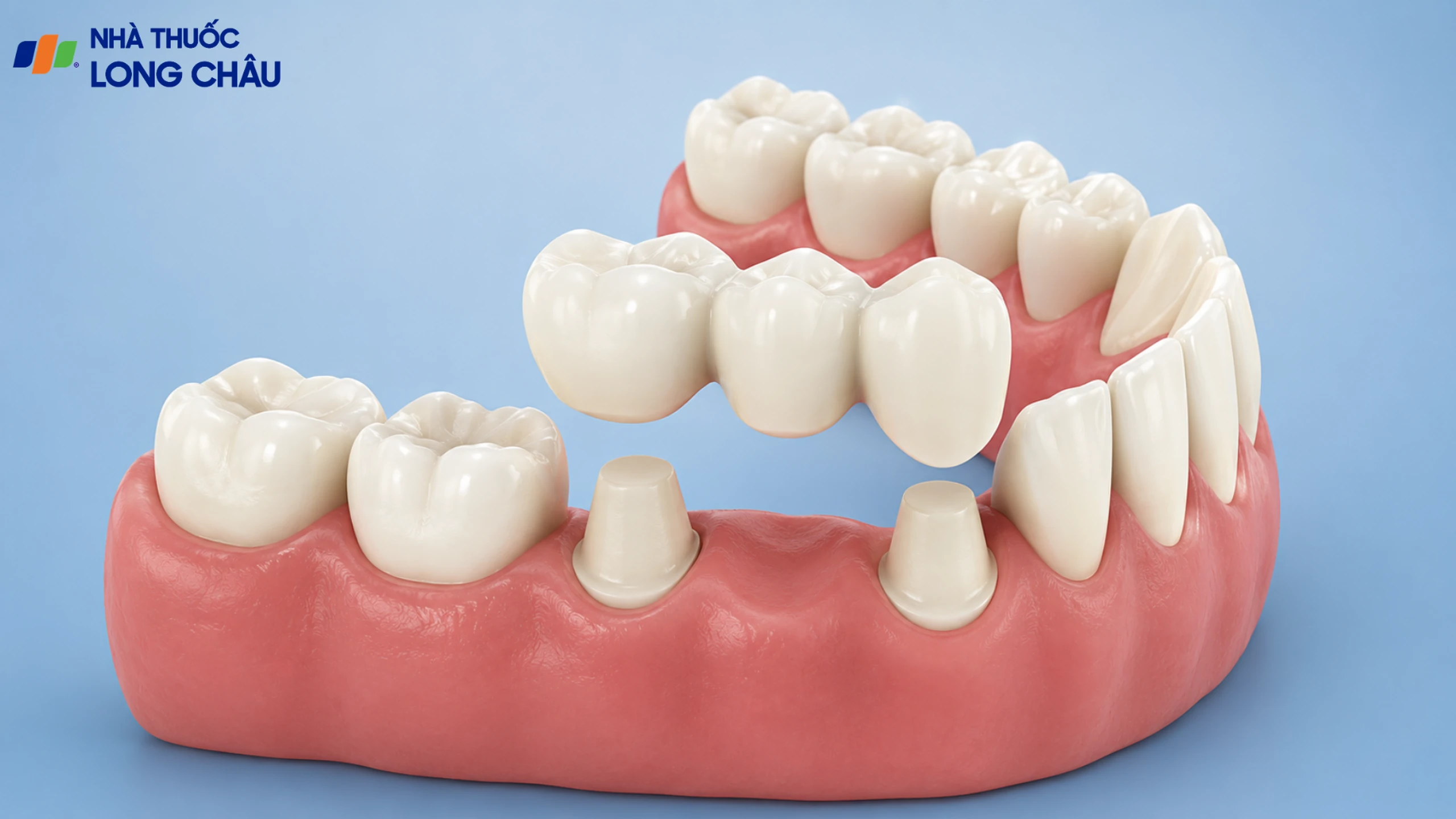 Bắc cầu răng sứ có bền không? Yếu tố ảnh hưởng và cách chăm sóc