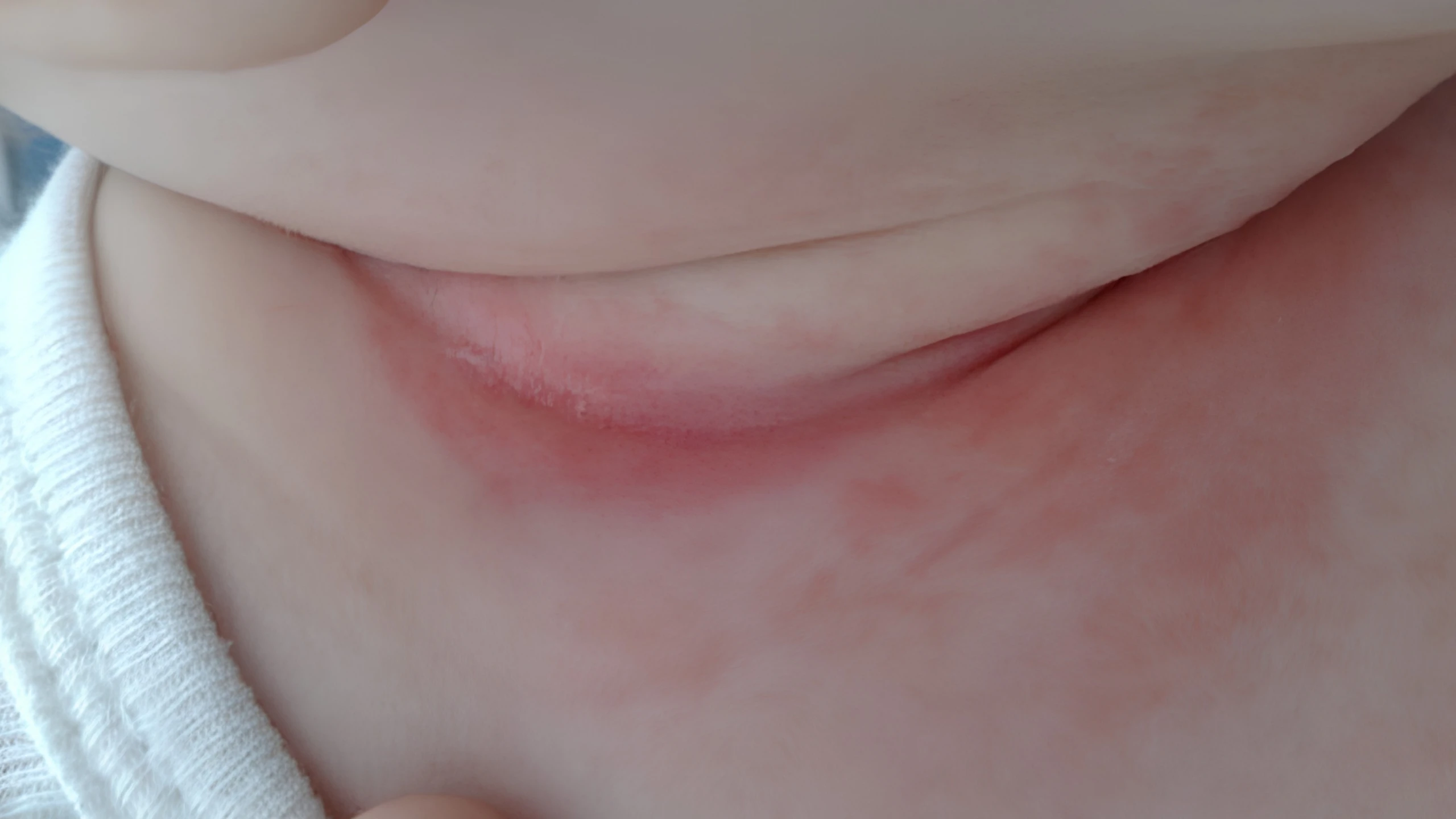 Nguyên nhân khiến trẻ sơ sinh bị nổi mẩn đỏ ở cổ và cách xử lý đúng