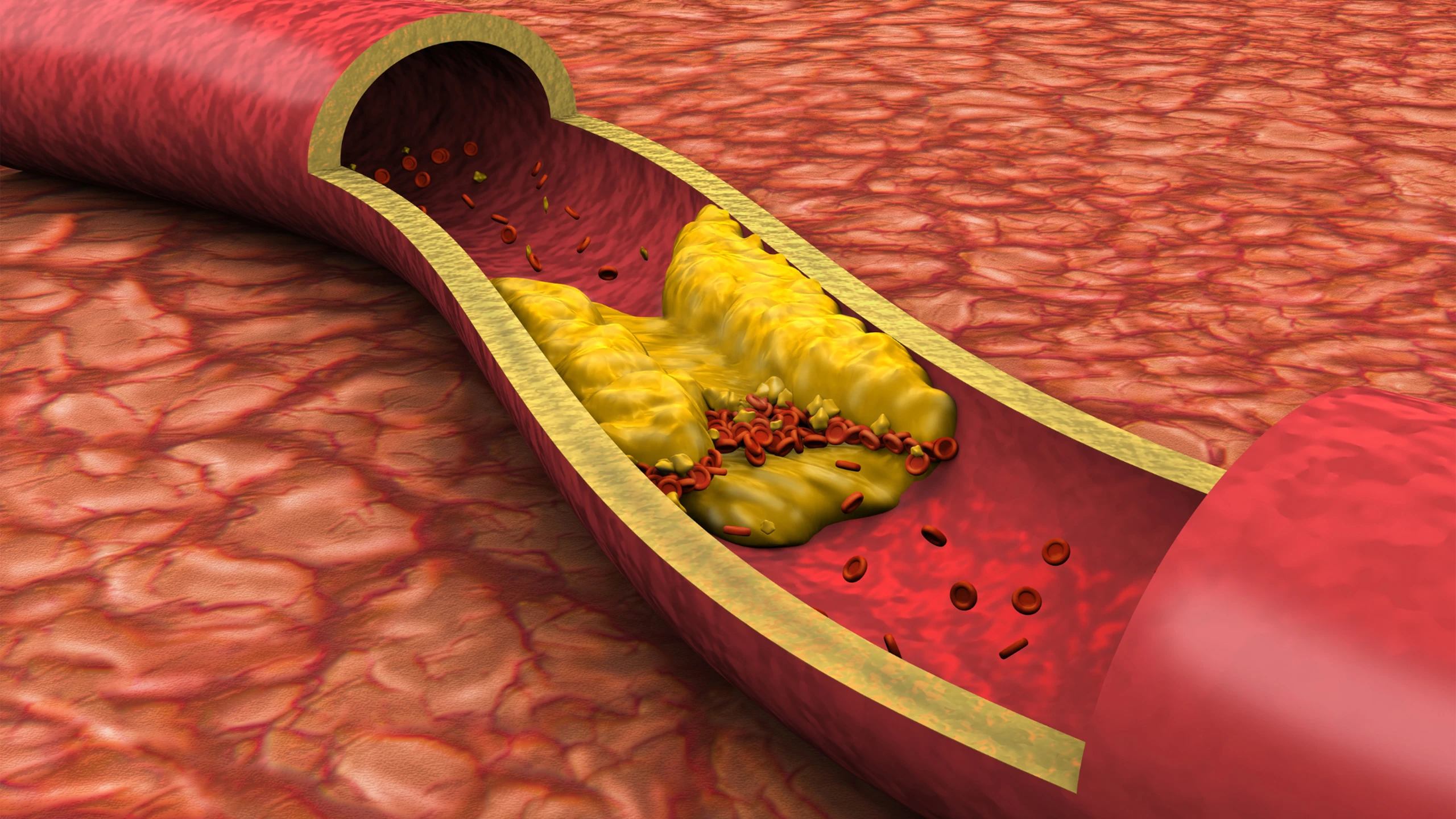 Bị cholesterol cao phải làm sao? Cách kiểm soát mỡ máu hiệu quả