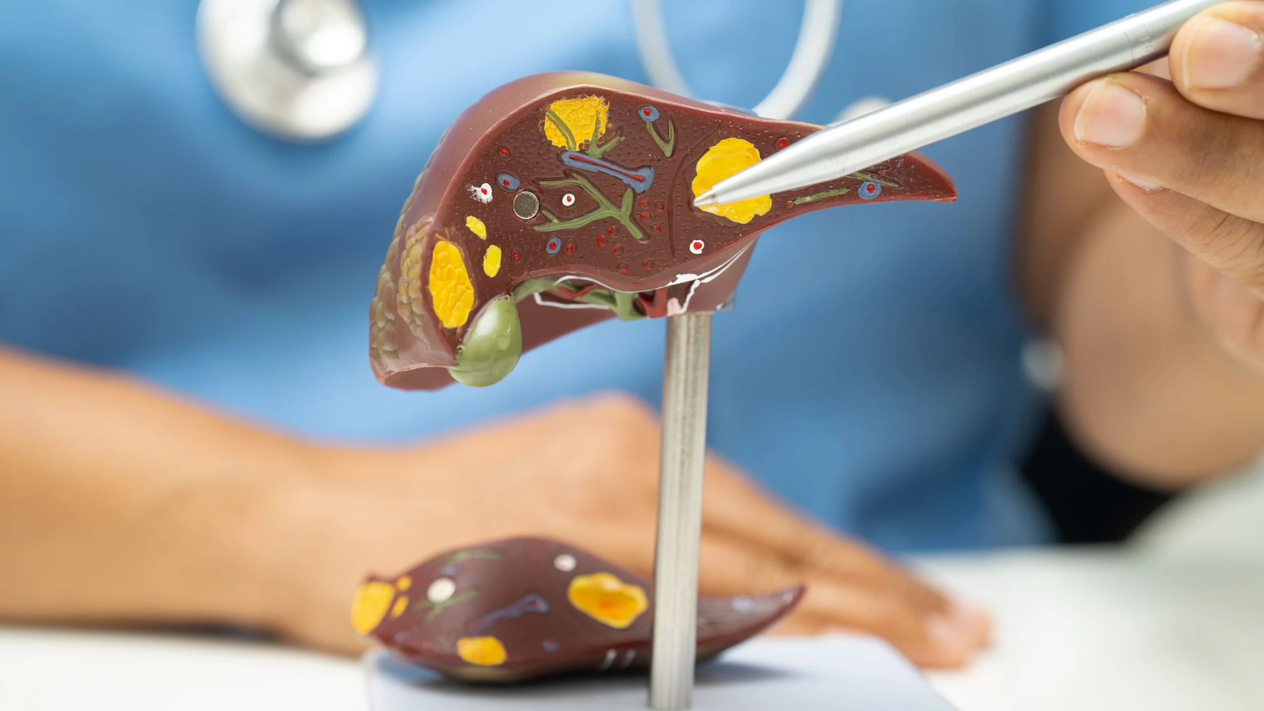 Bị men gan cao có cần dùng thuốc không? Một số phương pháp hạ men gan không cần dùng thuốc