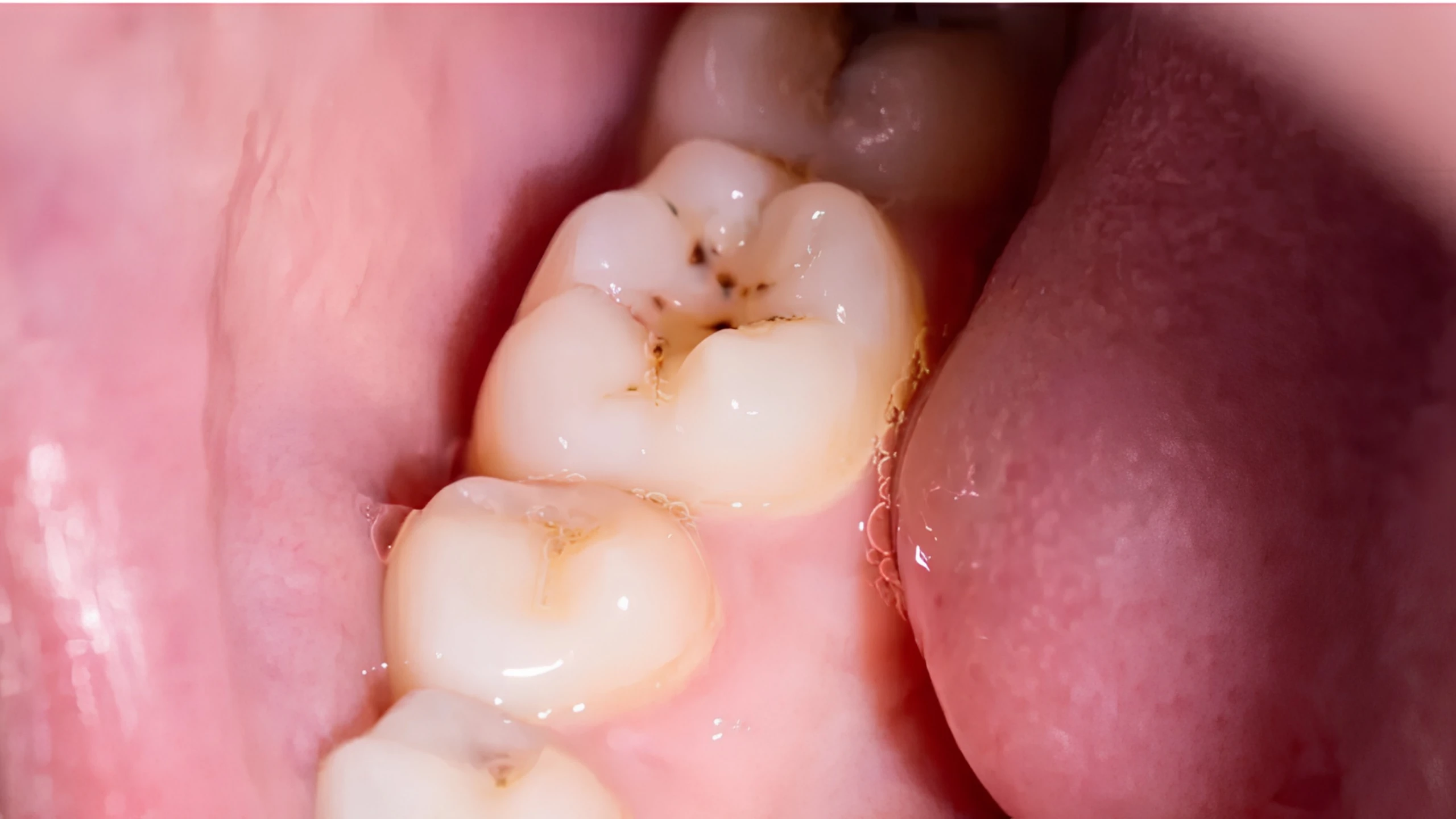 Bị sâu răng có đi Nhật được không? Cách phòng ngừa sâu răng hiệu quả