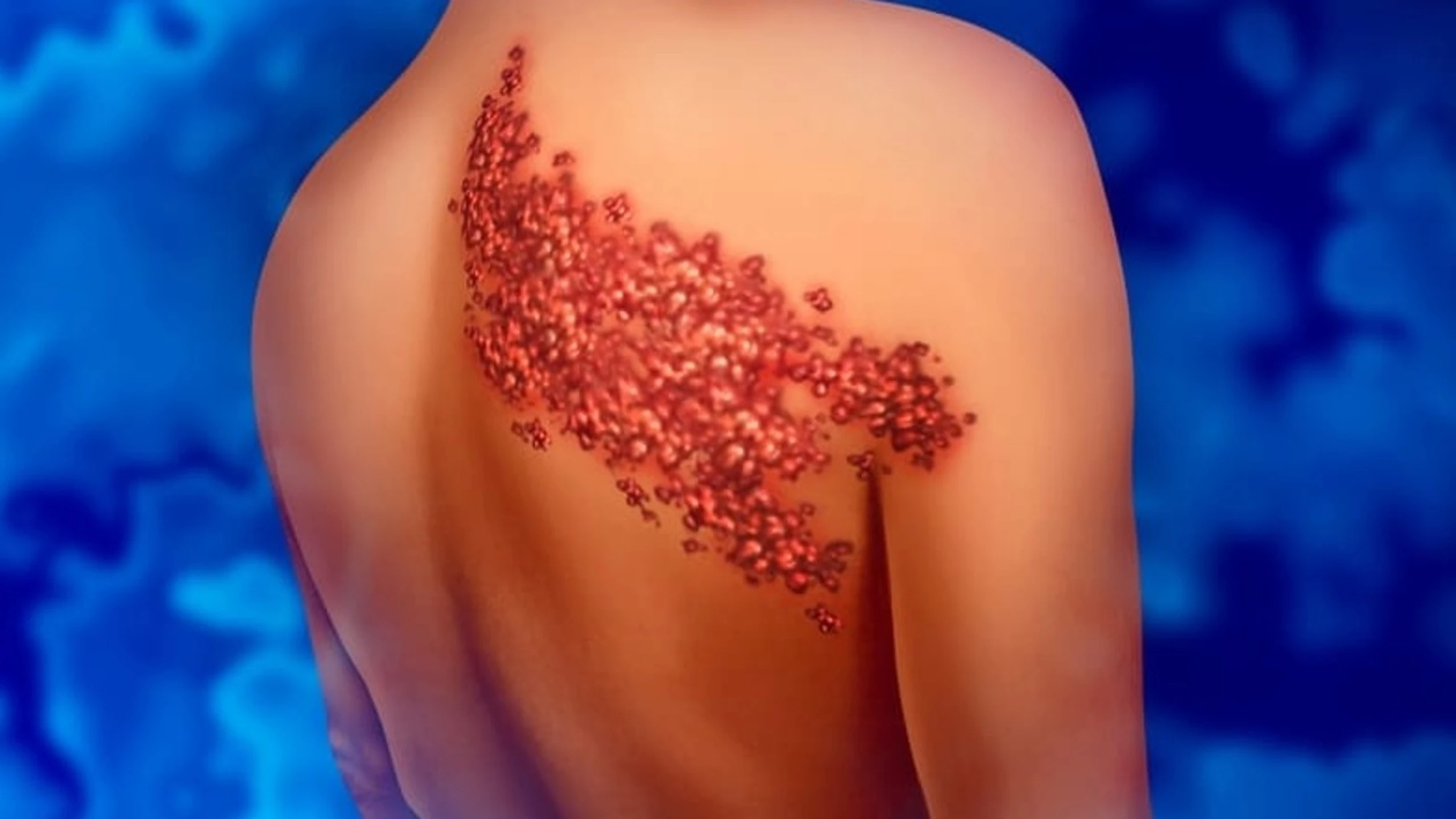 Bị zona có được tắm không​? Hướng dẫn cách tắm đúng cho người bệnh zona