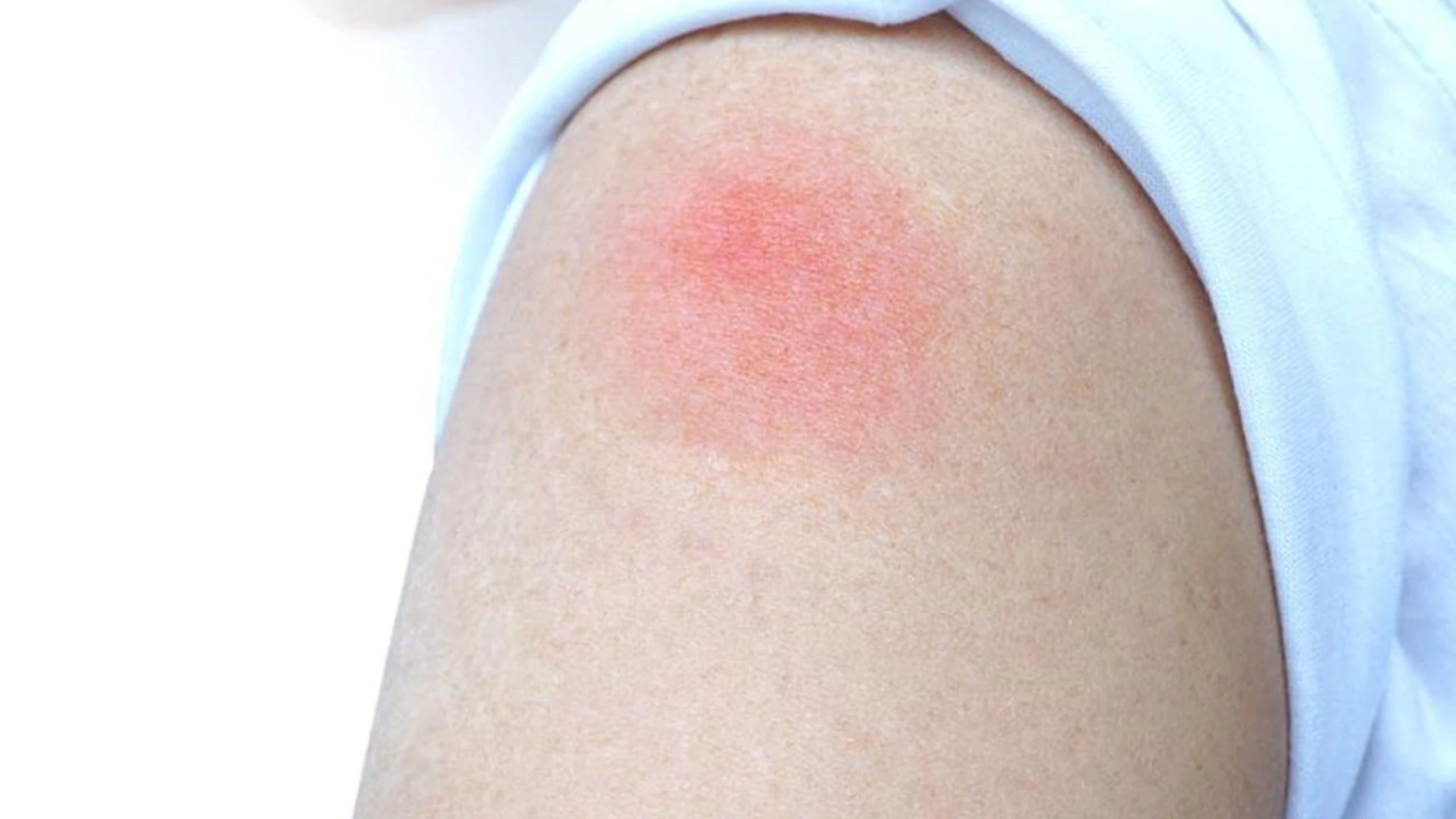 Biến chứng sau tiêm chủng: Những điều cần biết