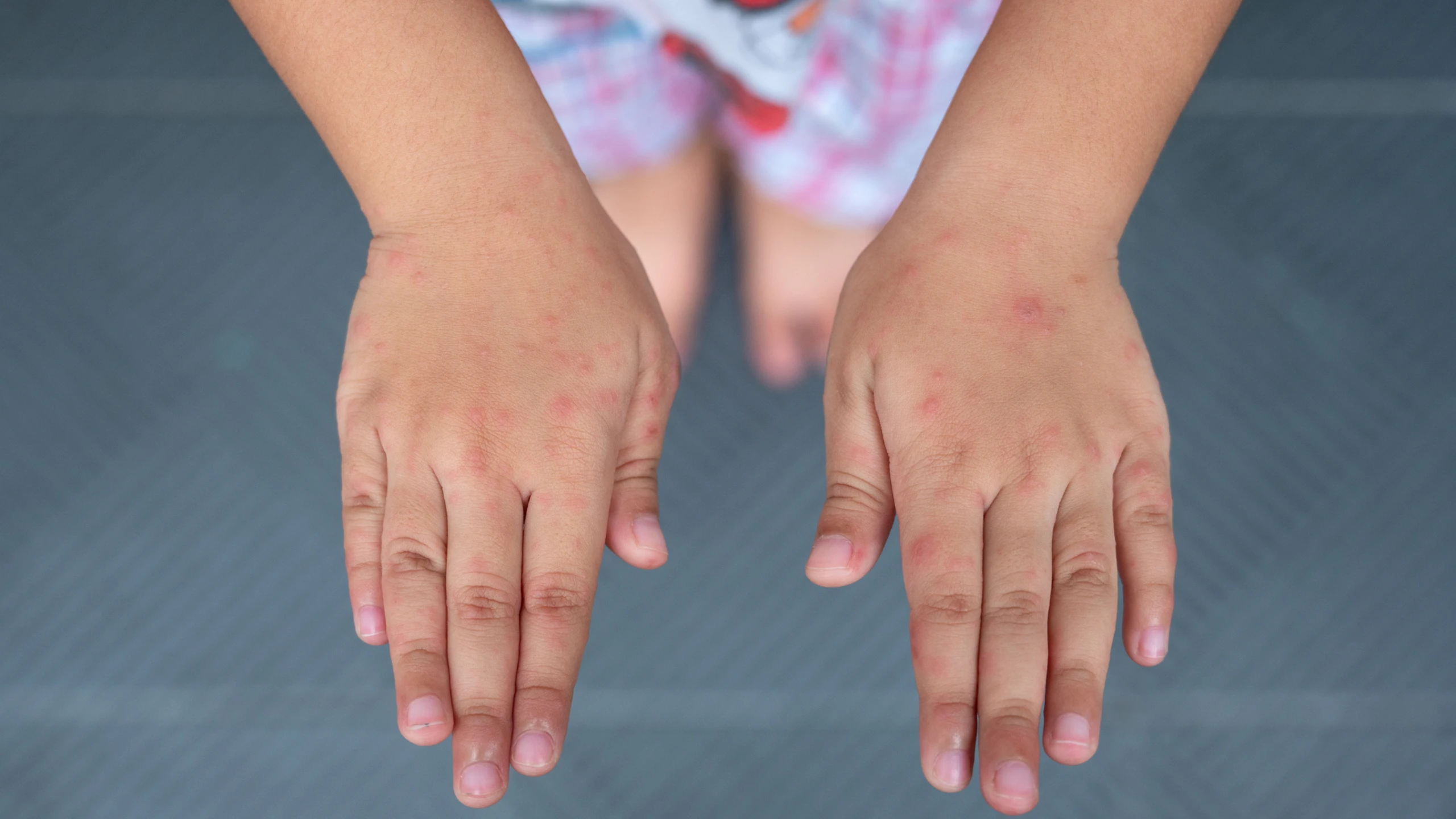 Ca tay chân miệng tăng hơn 5 lần, Lâm Đồng khẩn trương siết phòng dịch