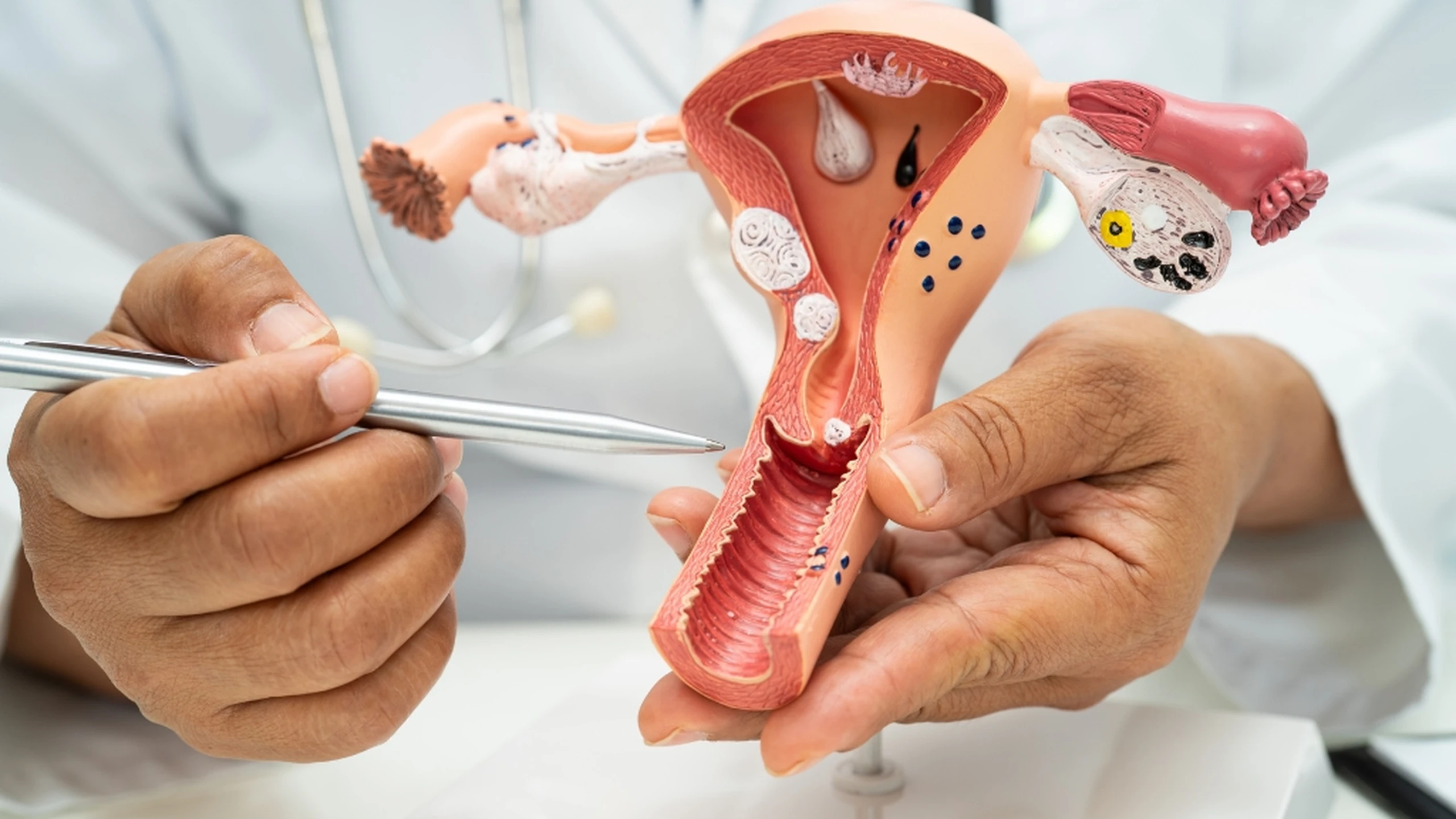 Cách chữa buồng trứng có nhiều nang nhỏ an toàn, hiệu quả