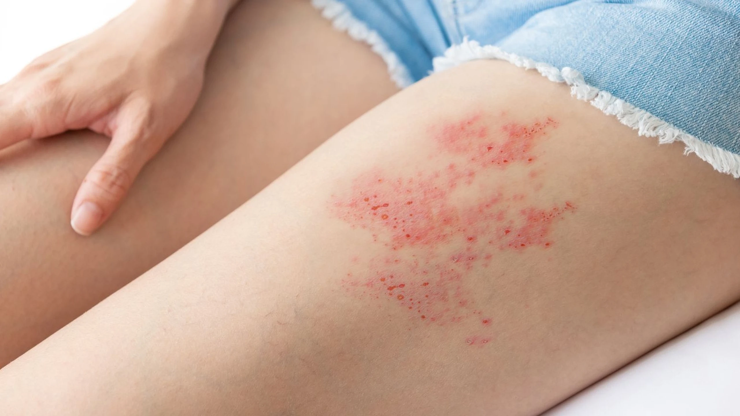 Cách dùng thuốc bôi zona thần kinh acyclovir