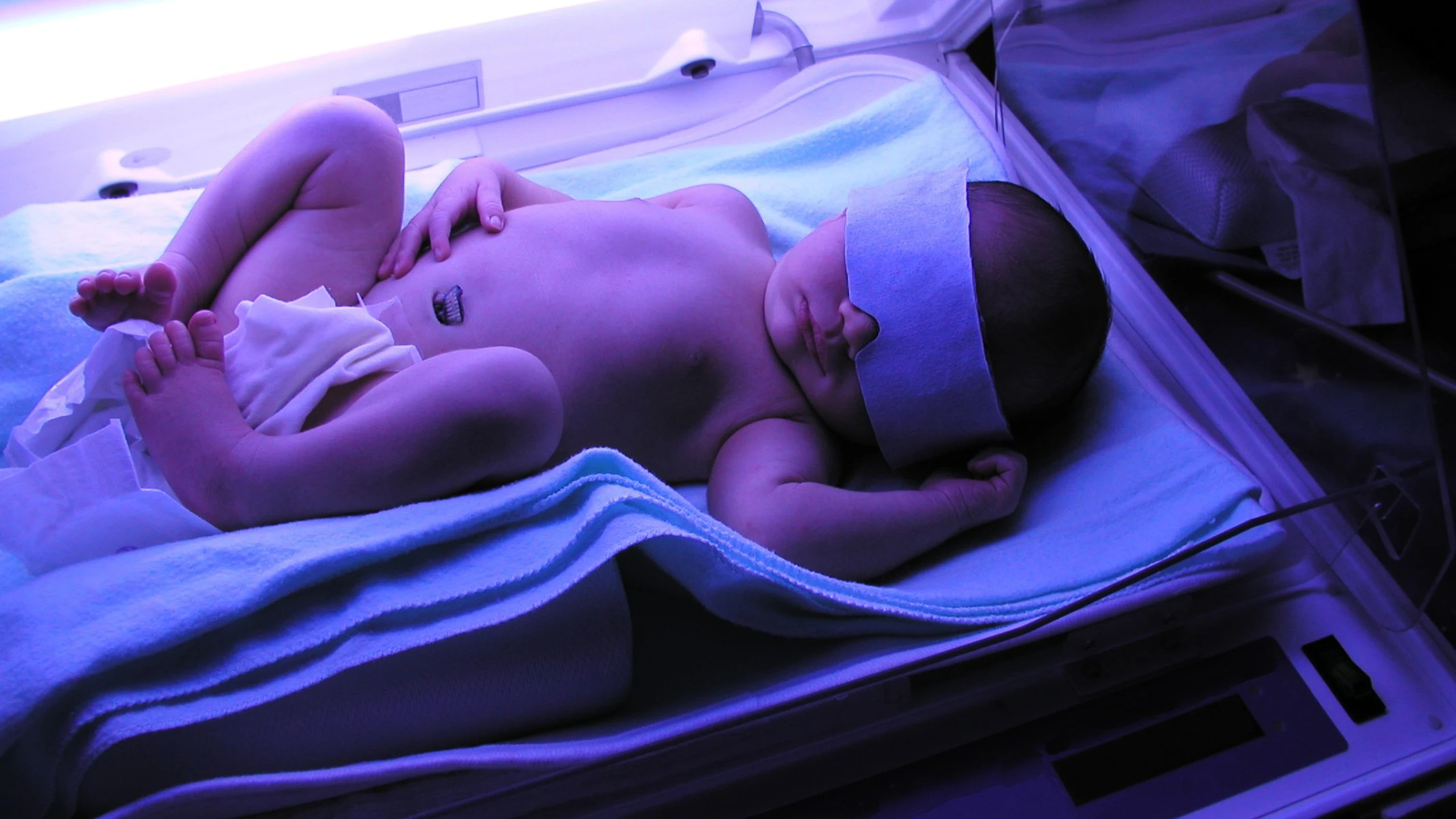 Chỉ số bilirubin bao nhiêu thì phải chiếu đèn​? Quy trình chiếu đèn vàng da cho trẻ sơ sinh