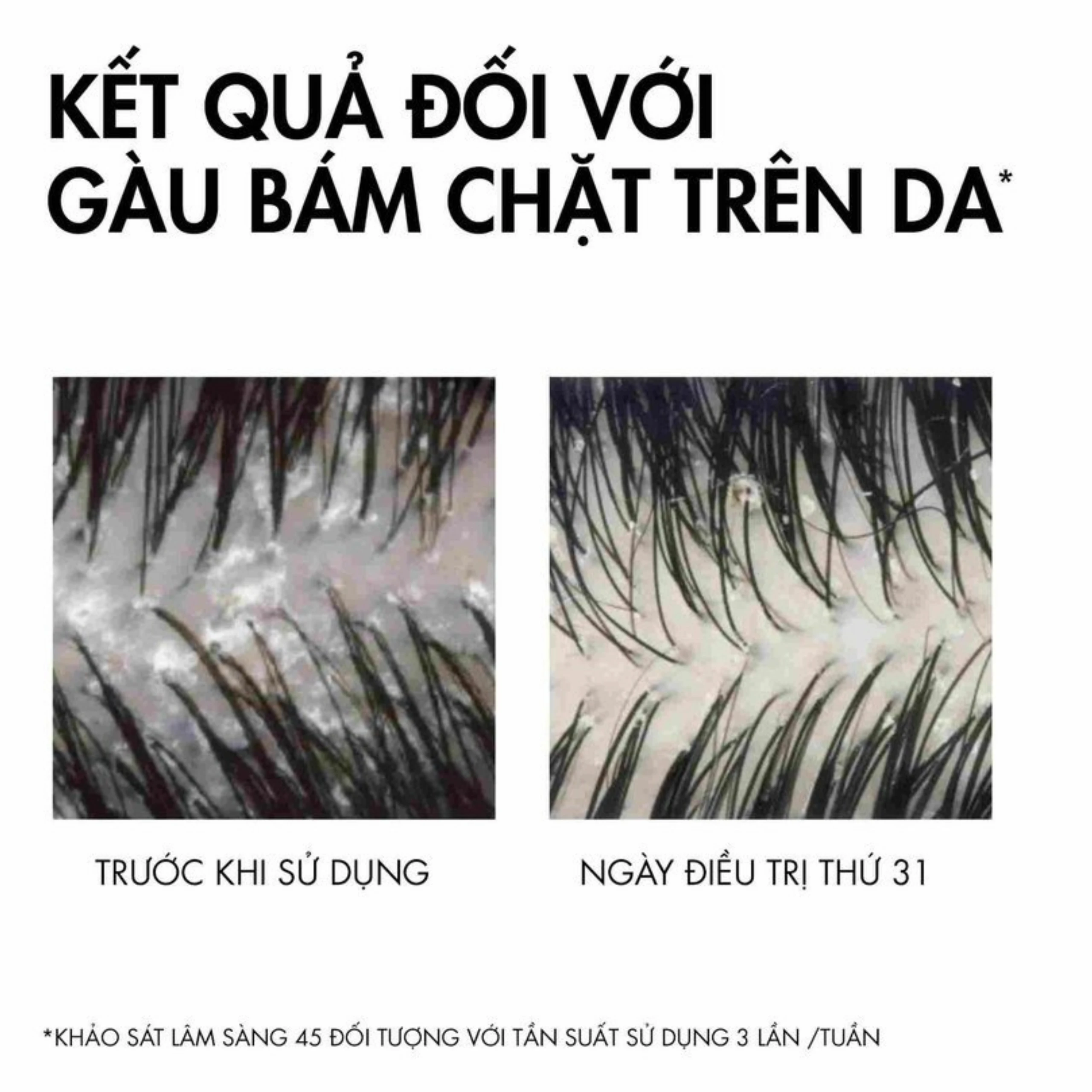 Dầu gội sạch gàu cho da đầu dầu Vichy Dercos Technique Anti Dandruff 75ml