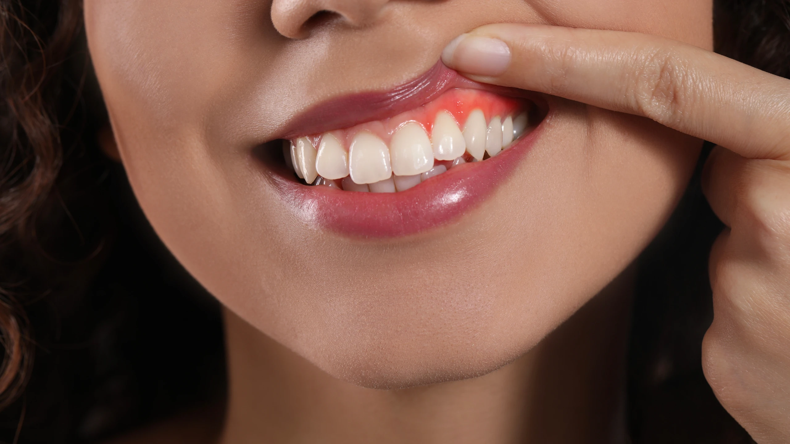 Dấu hiệu ung thư nướu răng và cách điều trị