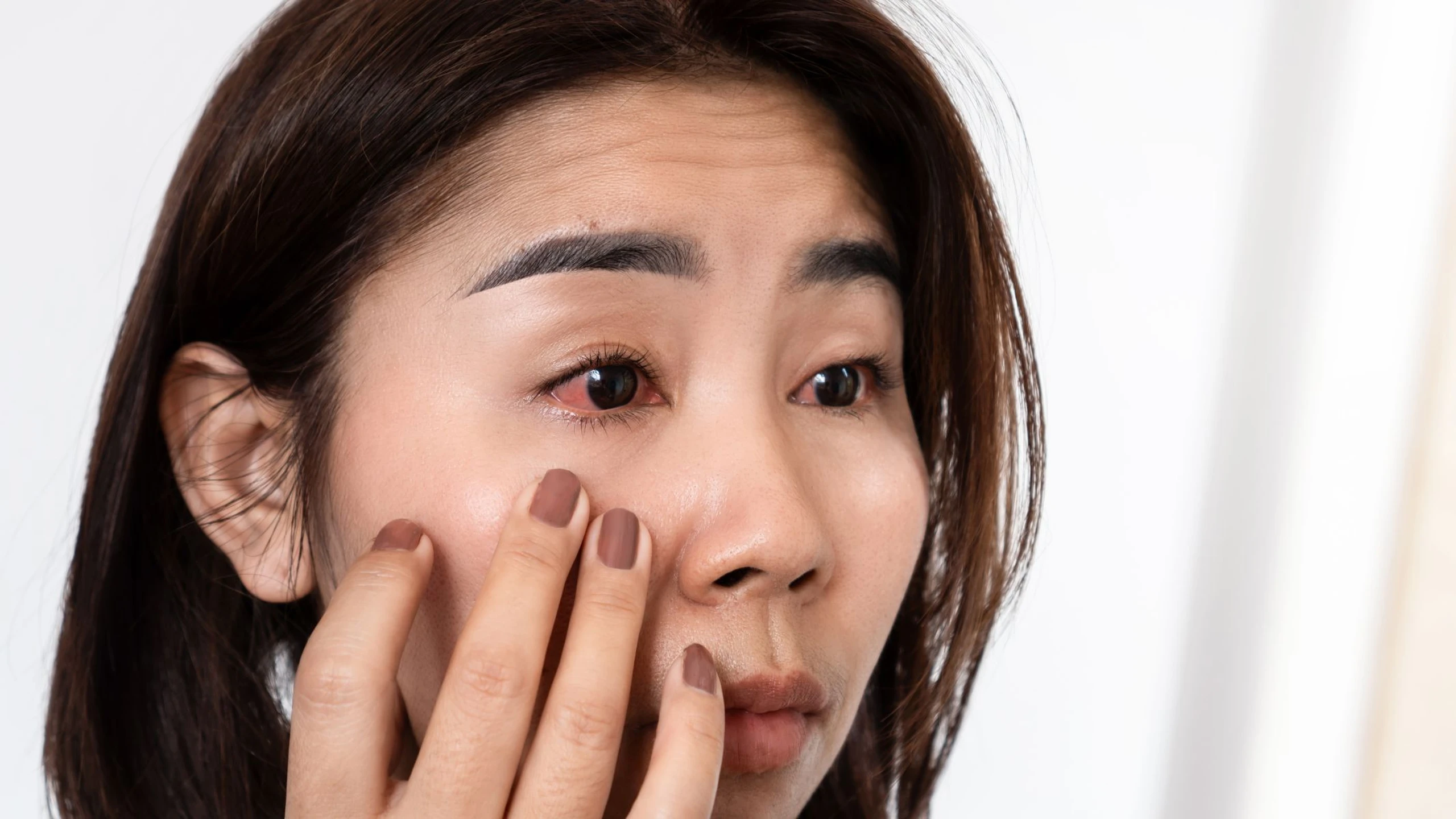 Đau mắt đỏ do vi khuẩn: Nguyên nhân, triệu chứng và cách điều trị