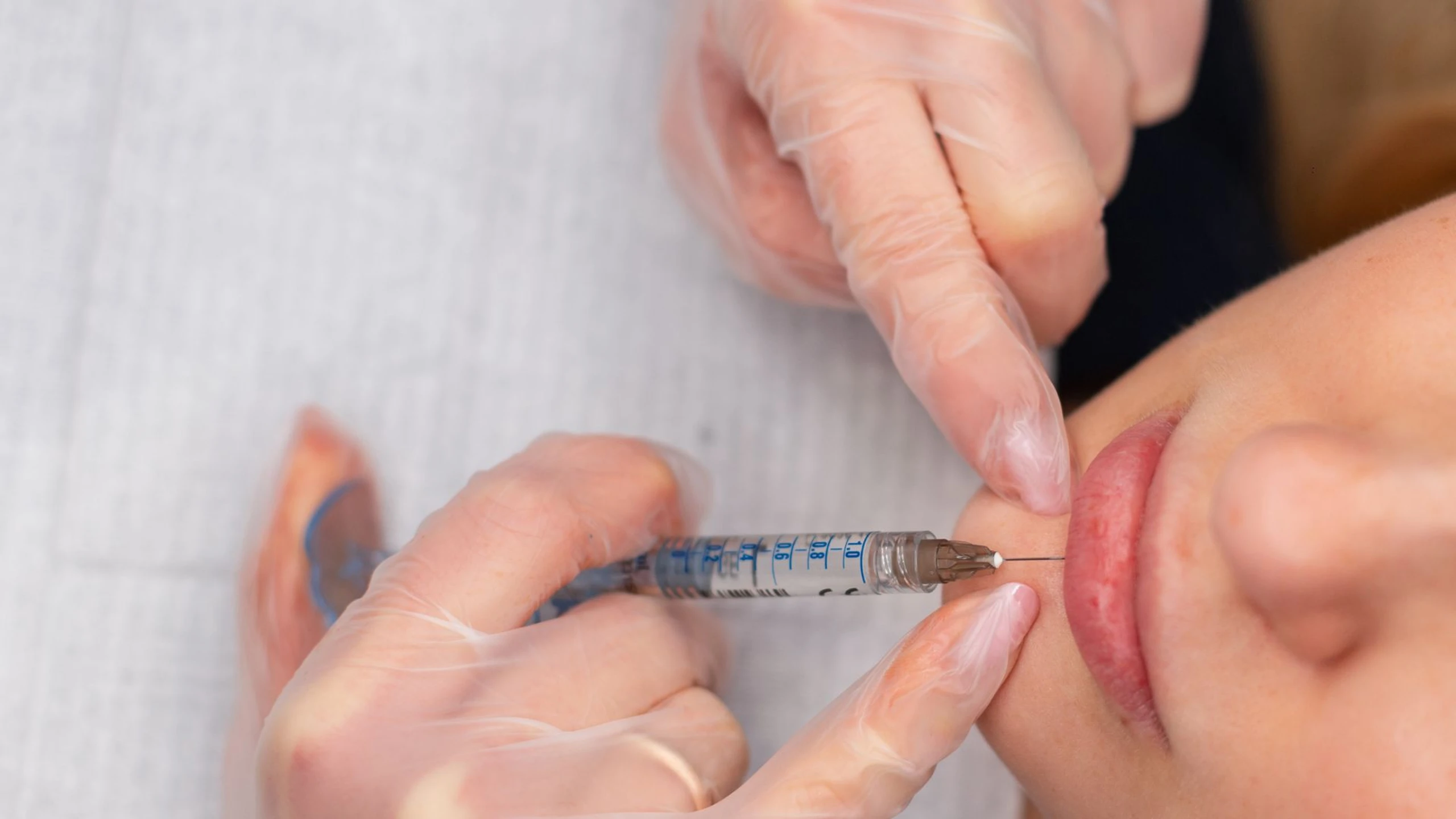 Dịch vụ tiêm môi bao nhiêu tiền? Những yếu tố ảnh hưởng đến giá tiêm môi