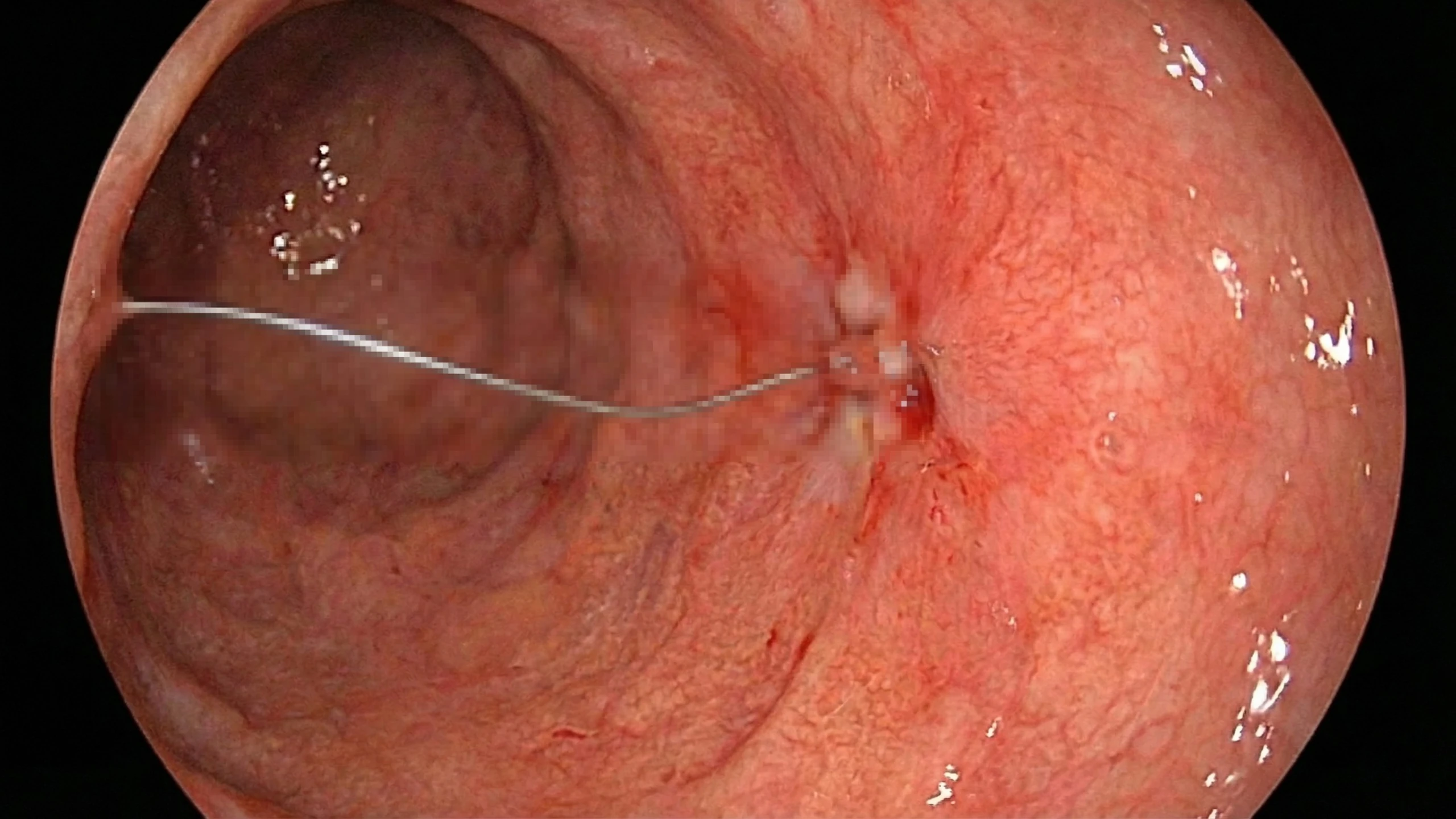 Gắp thành công sợi thép xuyên thành dạ dày bệnh nhân tại Hà Tĩnh