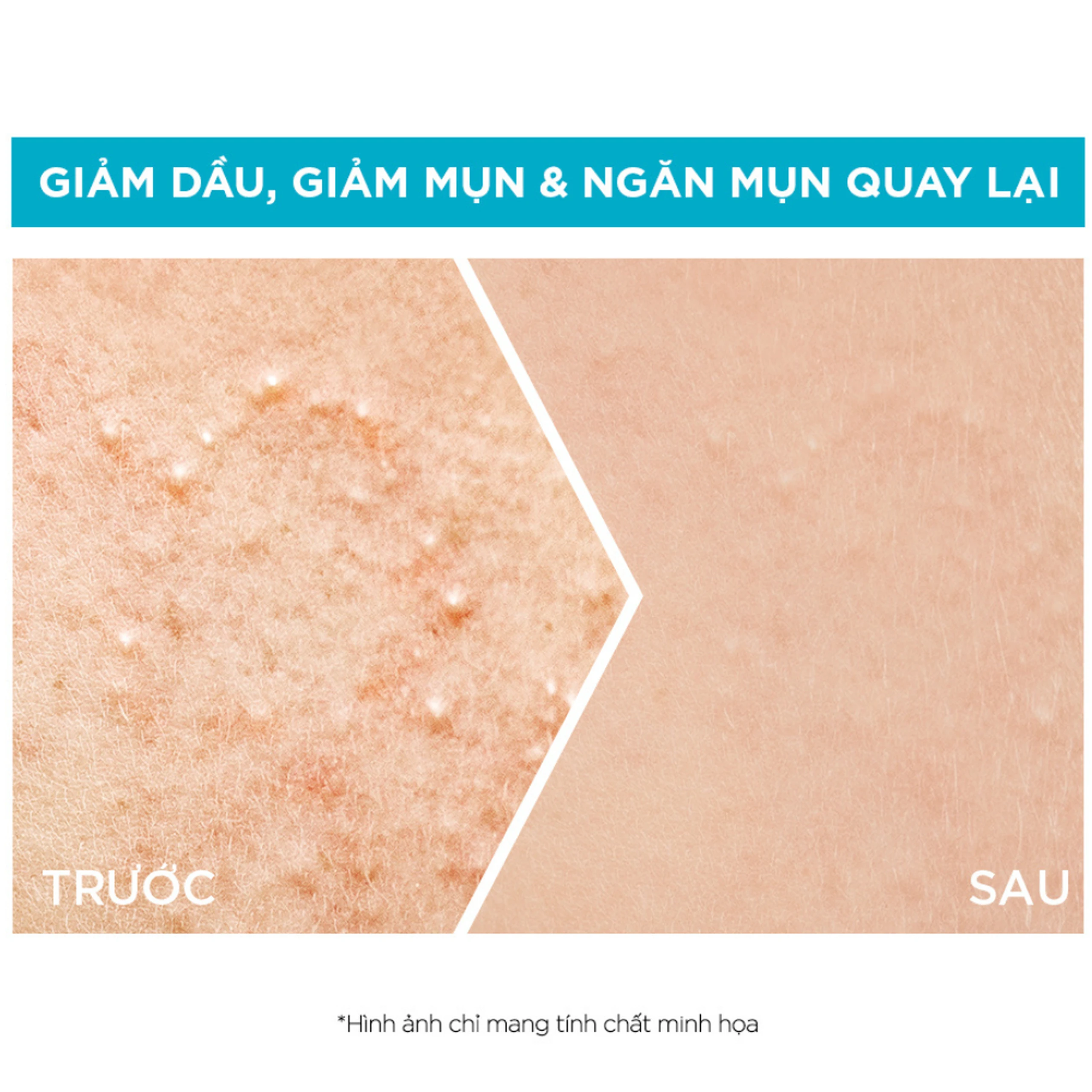 Tinh chất ngừa mụn Garnier Skin Naturals Bright Complete Anti Acne Booster Serum 30ml 4