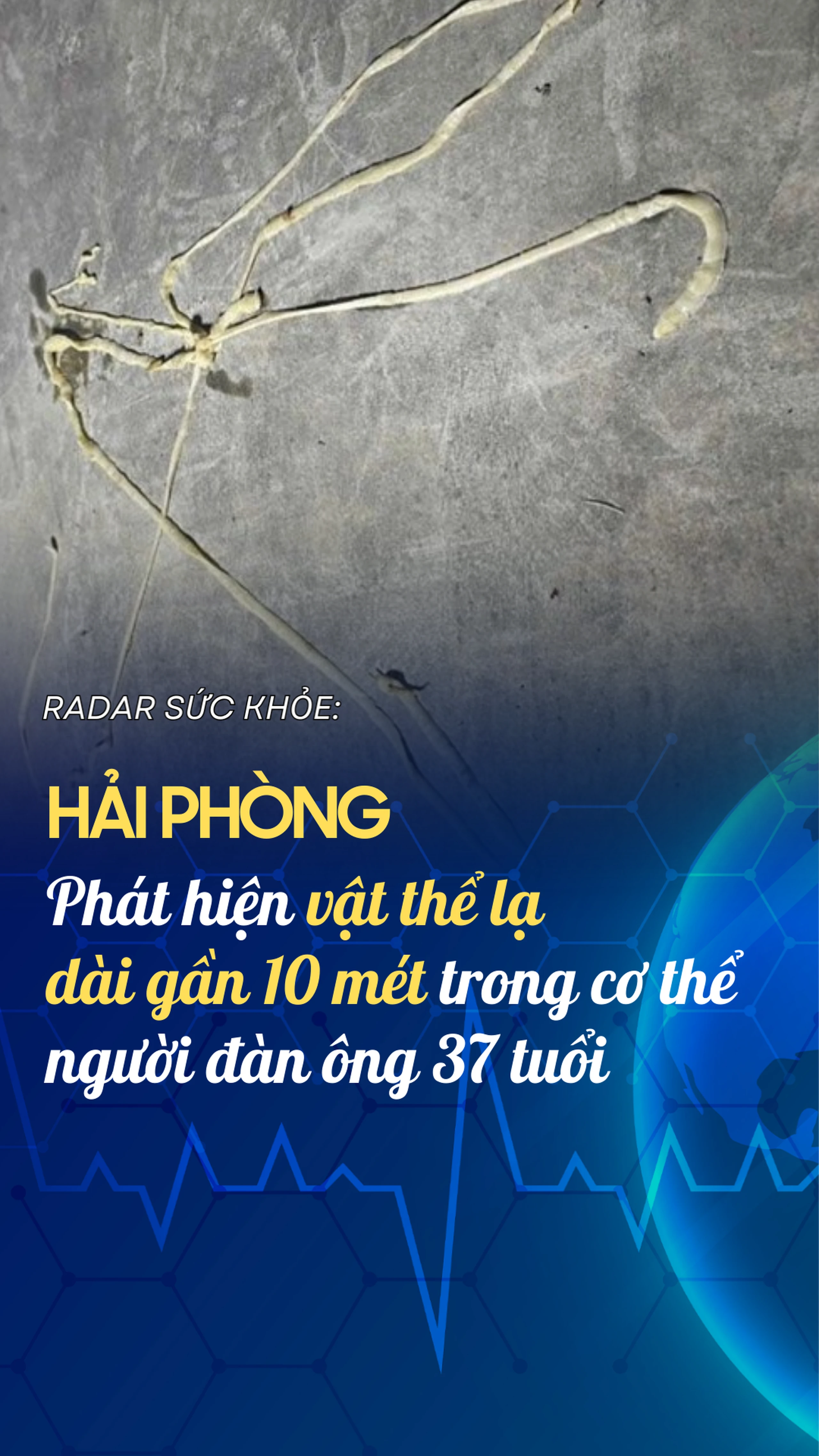 Hải Phòng: Phát hiện vật thể lạ dài gần 10 mét trong cơ thể người đàn ông 37 tuổi