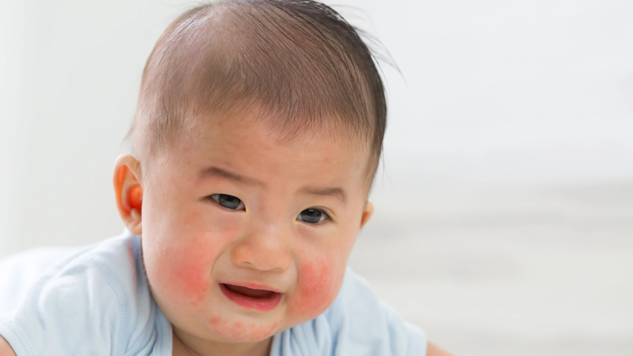 Hình ảnh bé bị dị ứng đạm sữa bò và cách khắc phục tình trạng này 0