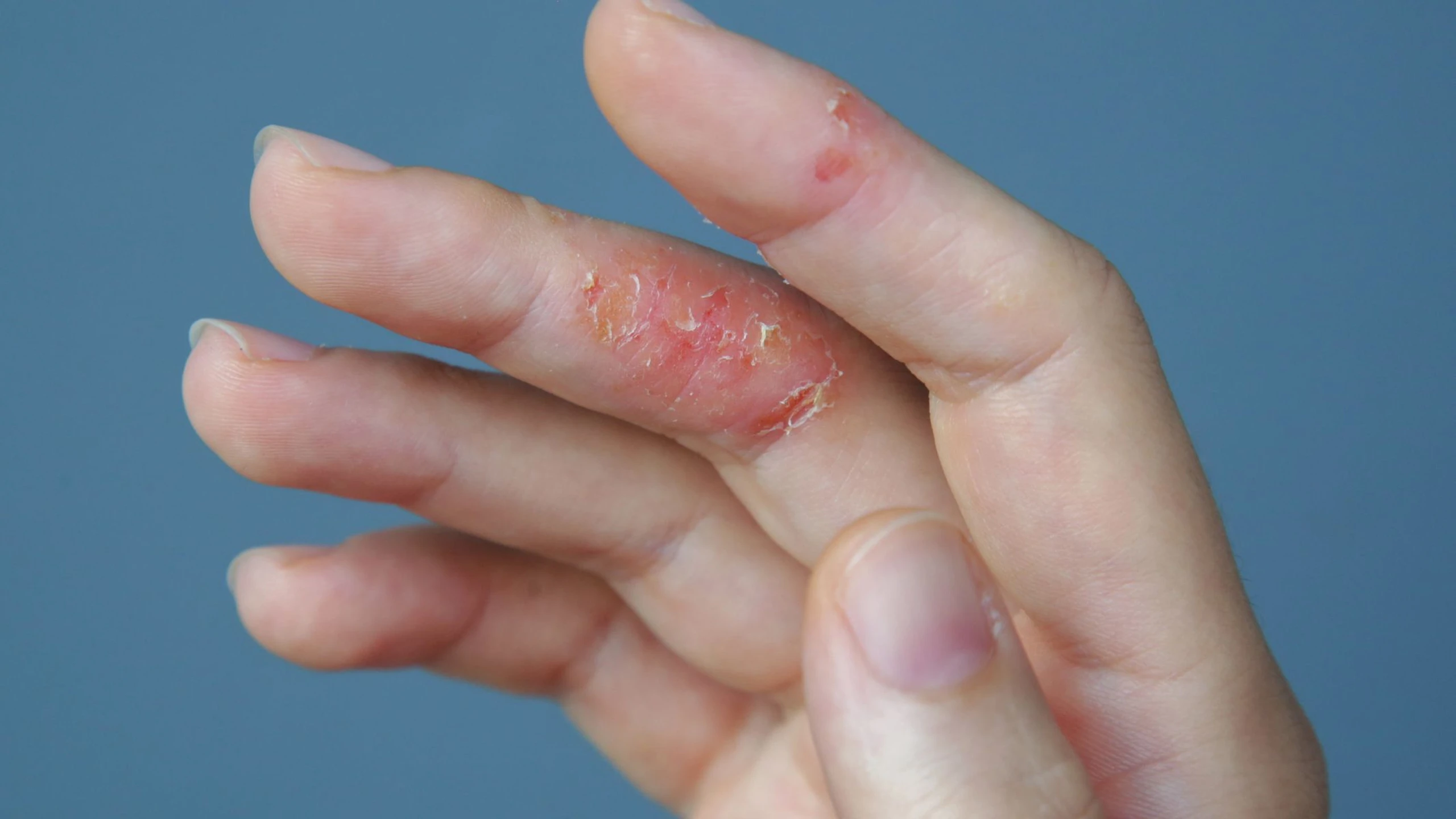 Hình ảnh bệnh nấm tổ đỉa từng loại dễ nhận biết và điều trị