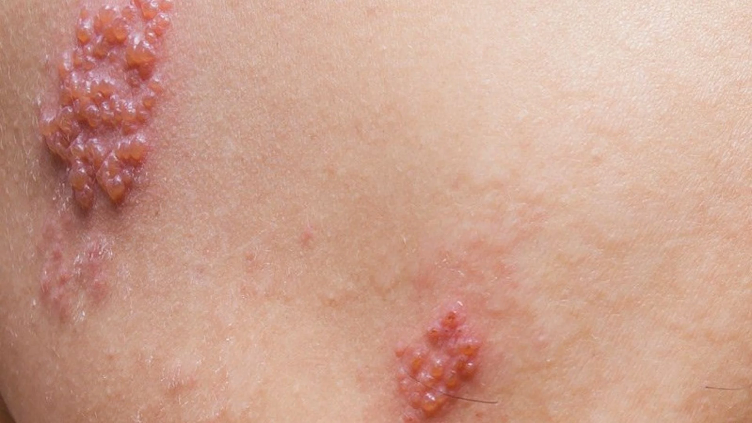 Hình ảnh bệnh zona thần kinh: Nhận biết sớm qua từng giai đoạn điển hình