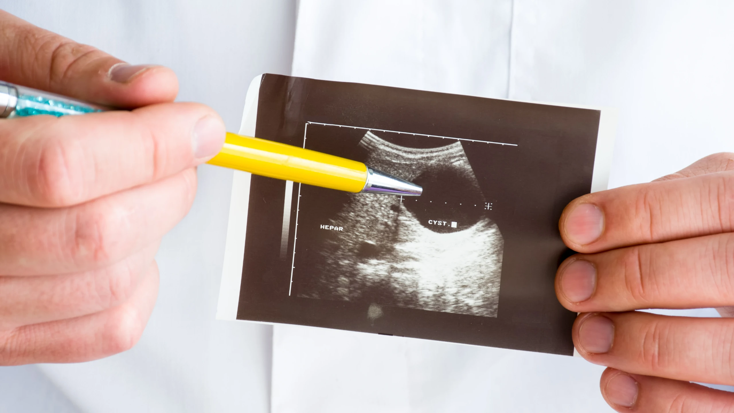 Hình ảnh siêu âm nang Naboth cổ tử cung: Khi nào cần theo dõi hoặc điều trị?