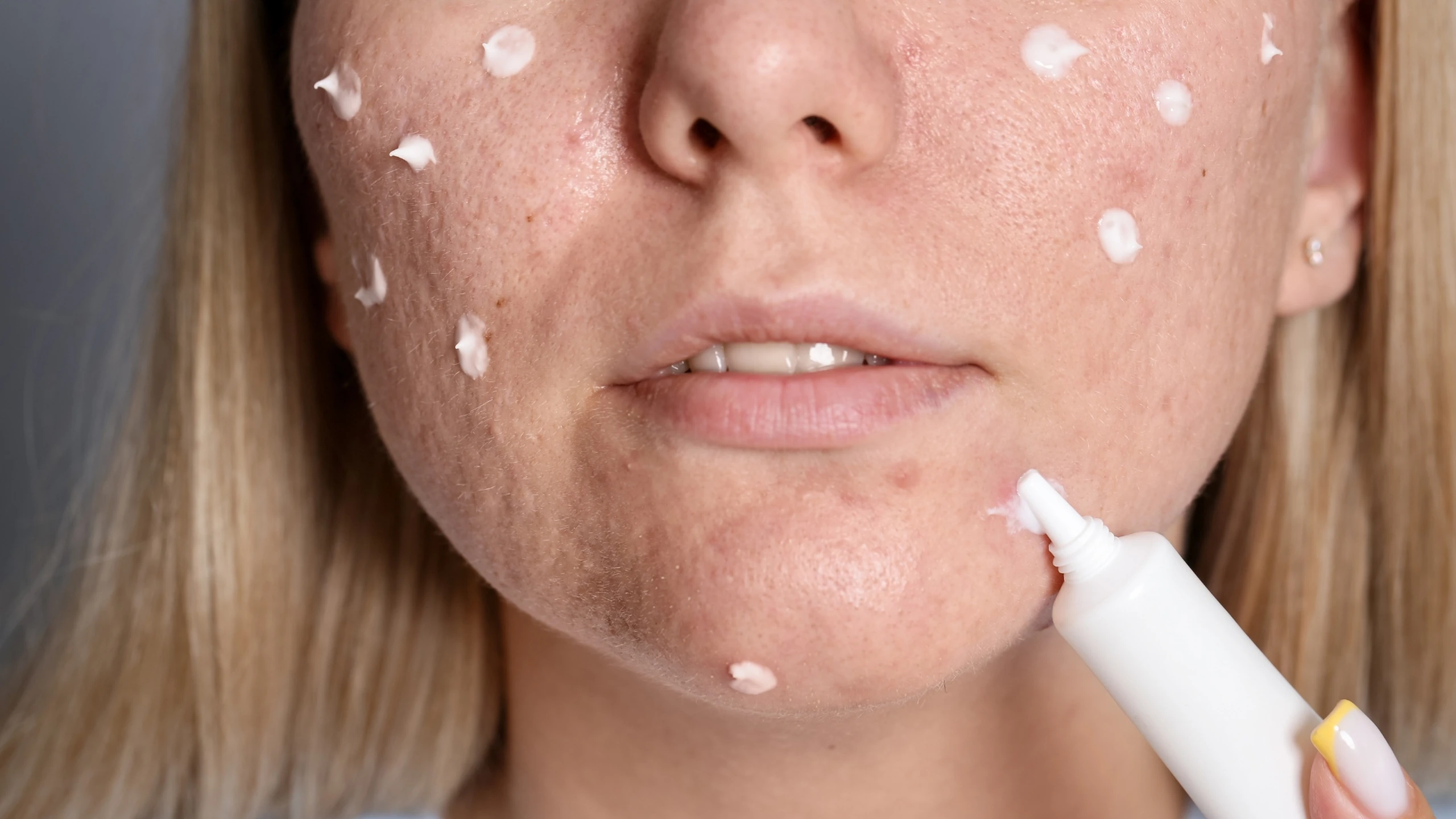 Hướng dẫn chăm sóc da mụn đúng cách và những điều cần biết