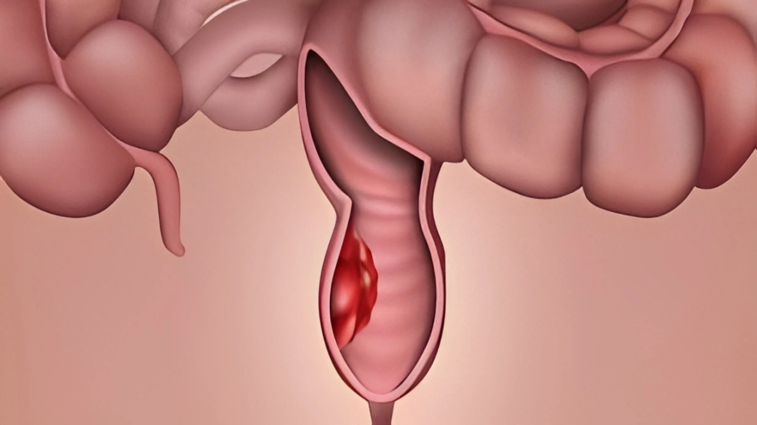 K trực tràng thấp: Nguyên nhân, triệu chứng và cách điều trị