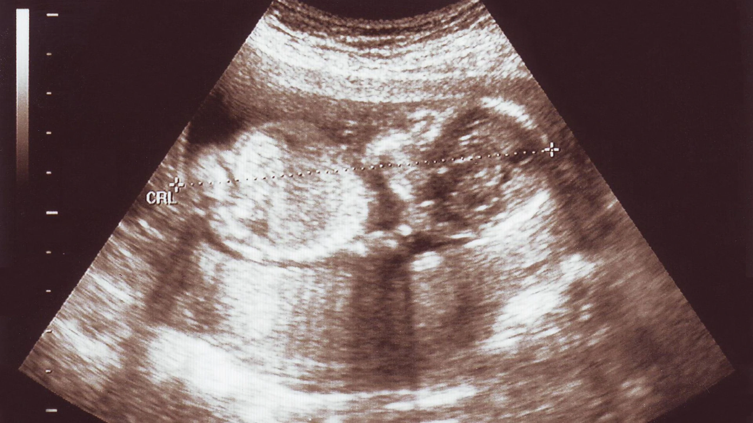 Khi thai 16 tuần nặng bao nhiêu gam? Sự phát triển của thai nhi 16 tuần như thế nào?