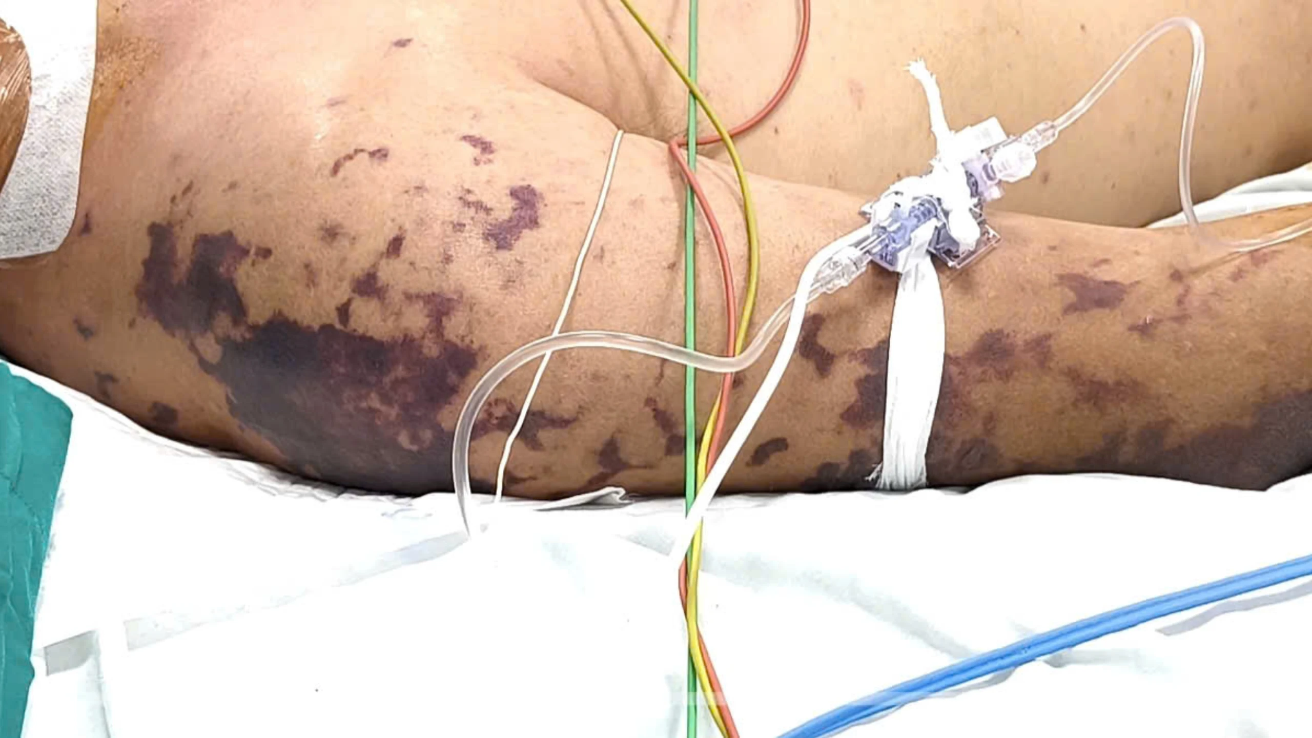 Khó thở, tím tái sau 2 ngày ăn cỗ, ca não mô cầu diễn biến nguy kịch