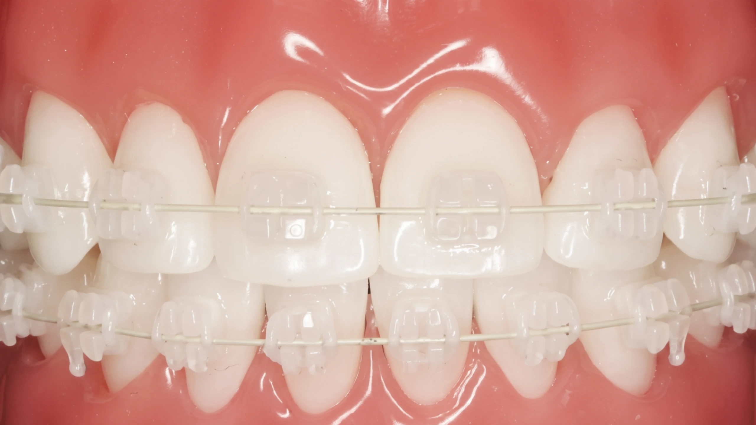 Mắc cài sứ thường: Giải pháp niềng răng thẩm mỹ với chi phí hợp lý