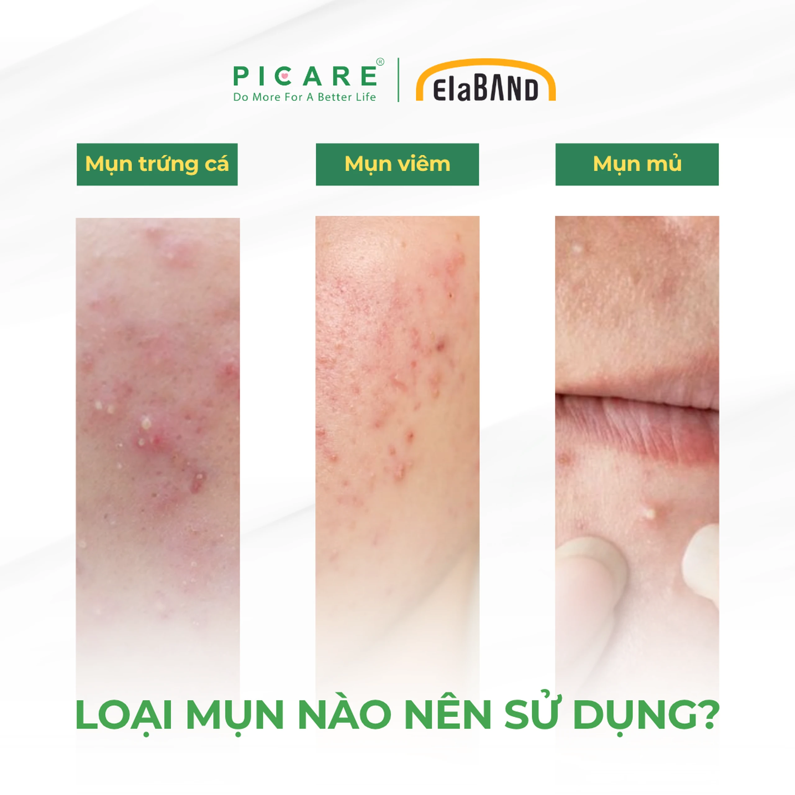 Miếng dán mụn Elaband Hydrodot Teatree (23 miếng) hút dịch mụn, giảm sưng viêm 4
