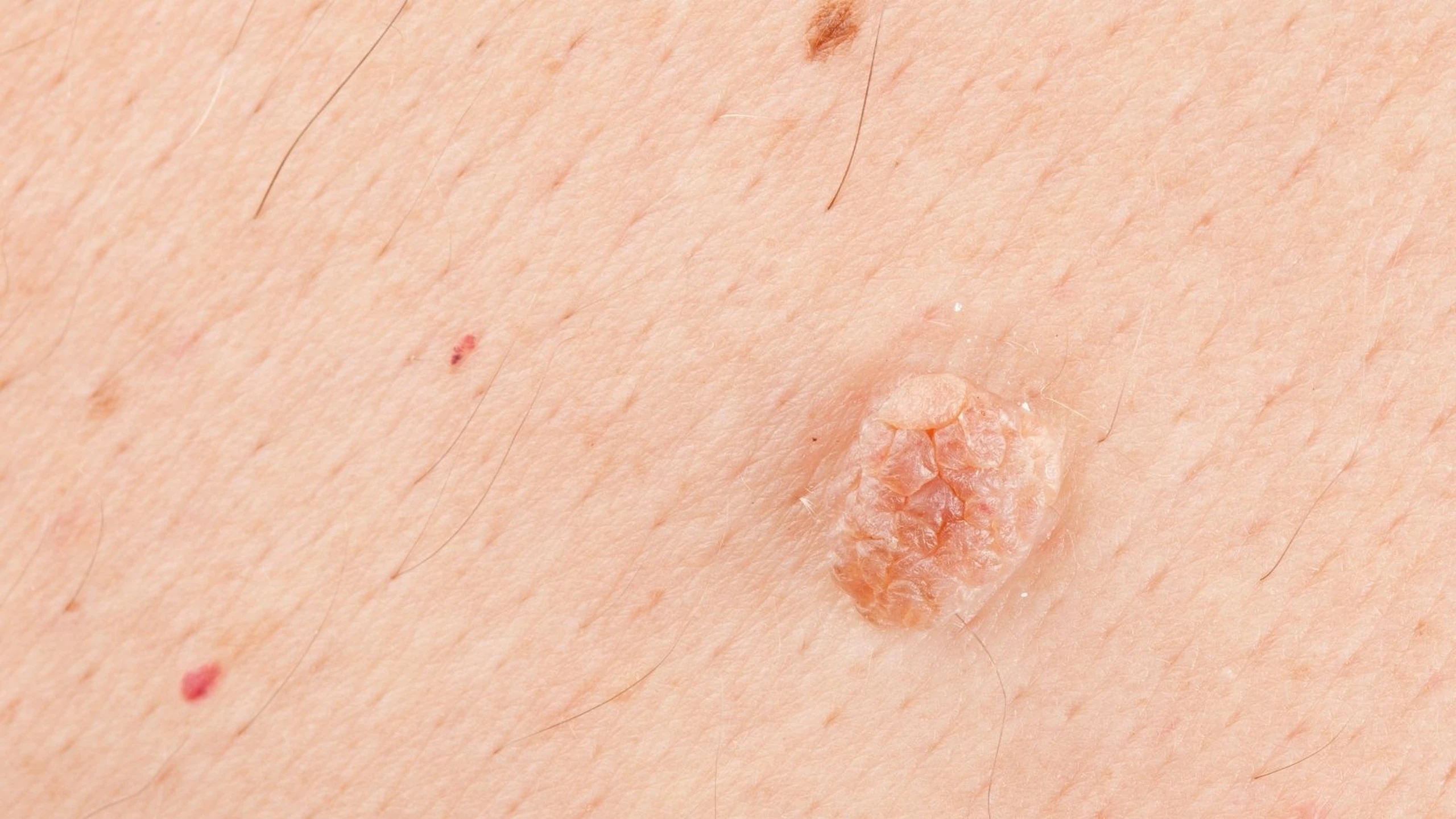 Mụn cóc sinh dục ở nữ: Dấu hiệu nhận biết, nguyên nhân và cách điều trị