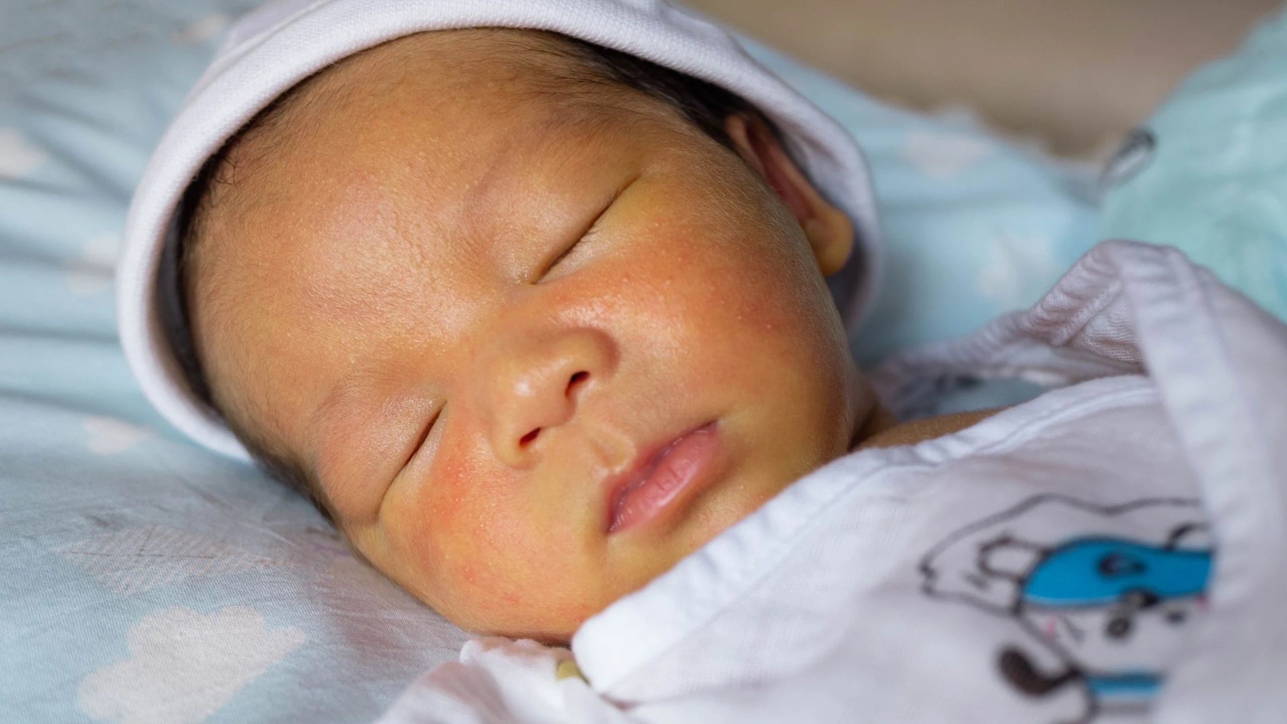 Mụn pustular melanosis: Nguyên nhân và triệu chứng