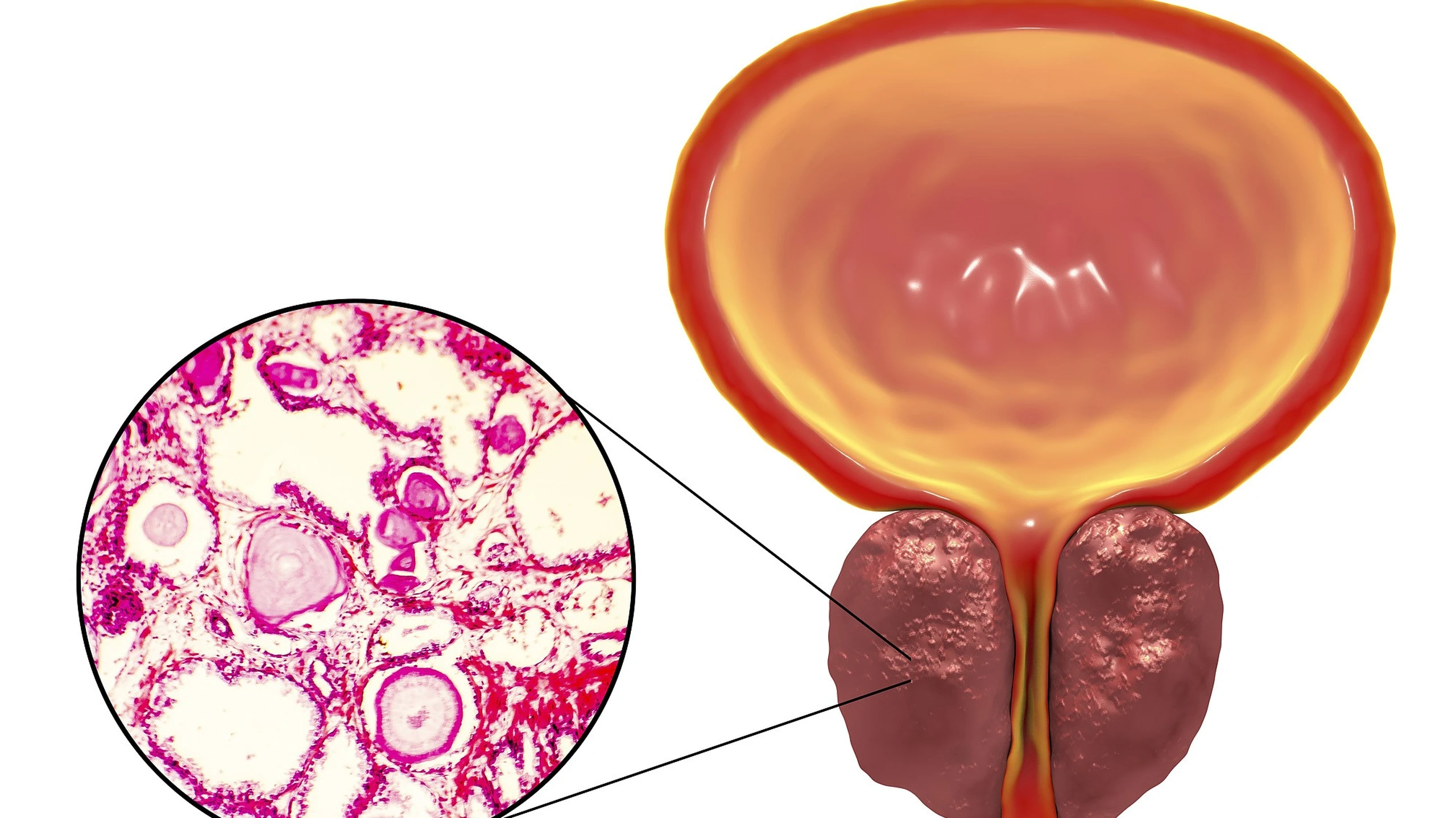 Nang tuyến tiền liệt: Nguyên nhân và biện pháp chăm sóc người bệnh