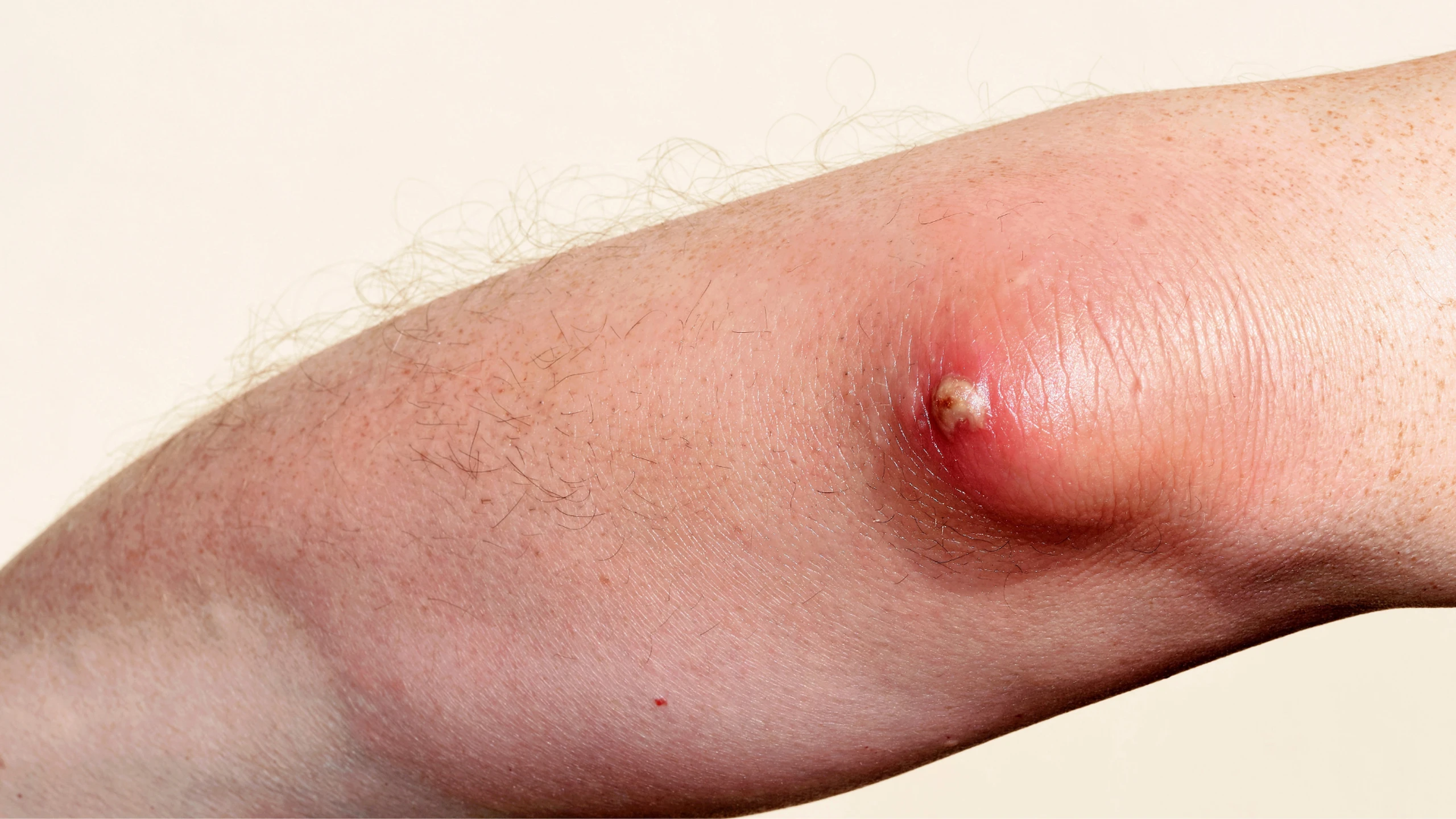 Áp xe tự vỡ có nguy hiểm không? Cách xử lý khi bị áp xe