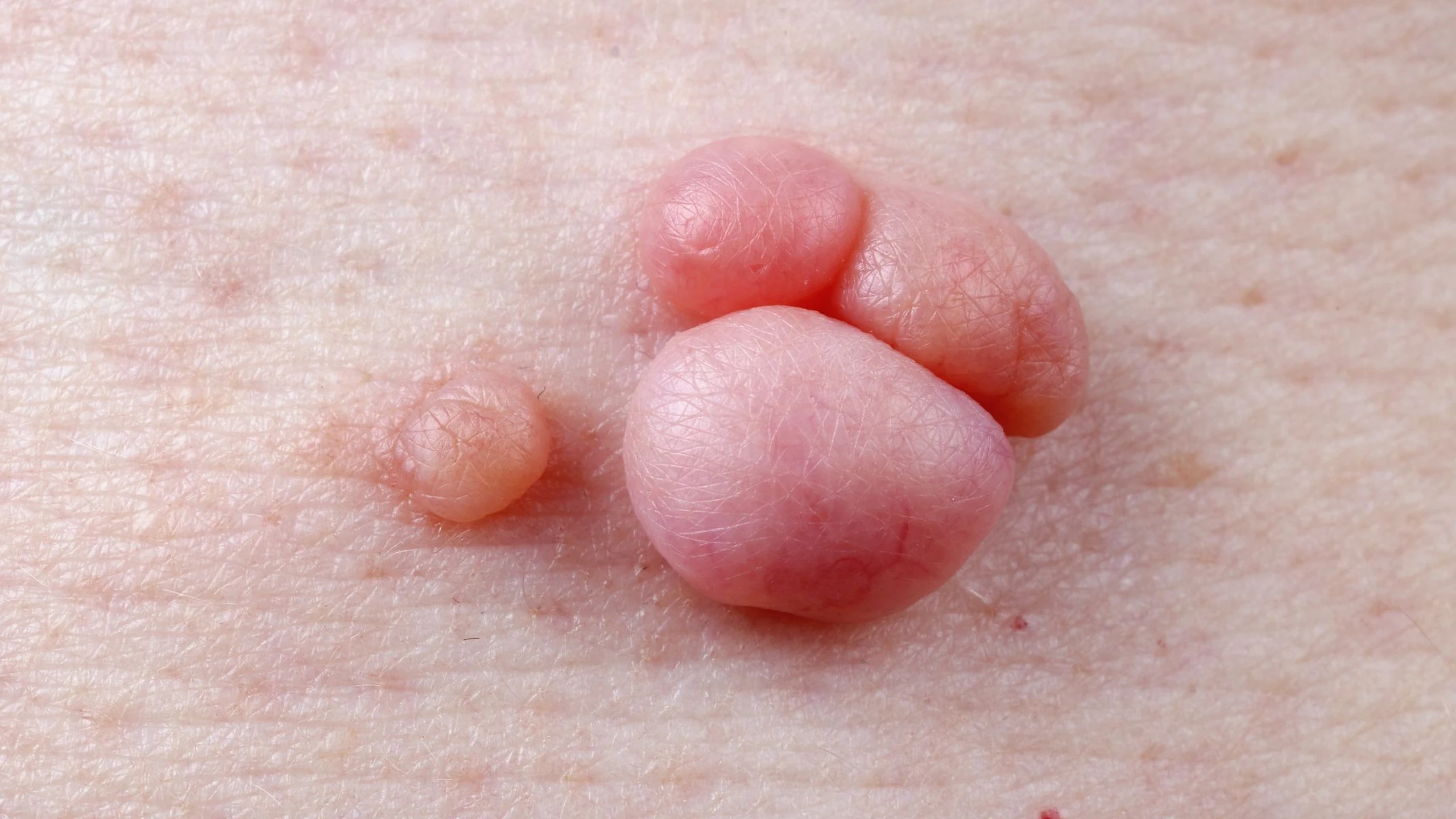 Nguyên nhân sùi mào gà là gì? Phương pháp điều trị sùi mào gà