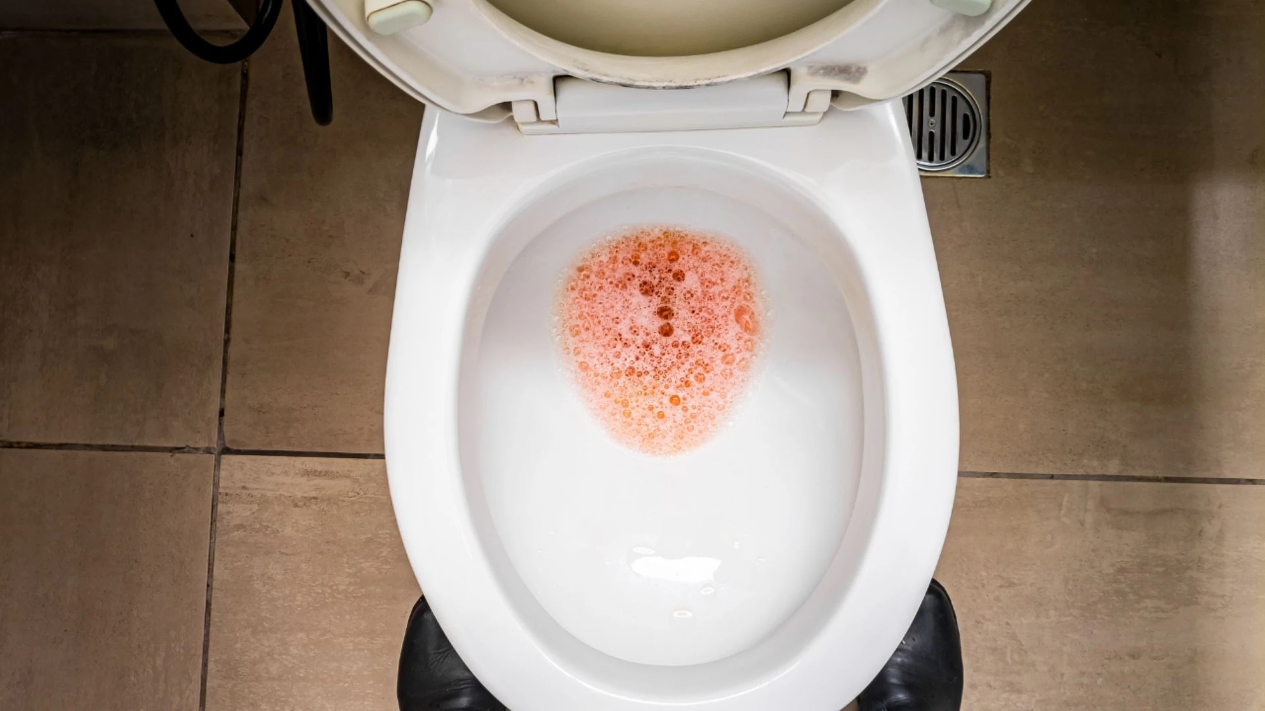 Nước tiểu có bọt ở nữ giới: Nguyên nhân, mức độ nguy hiểm và khi nào cần đi khám