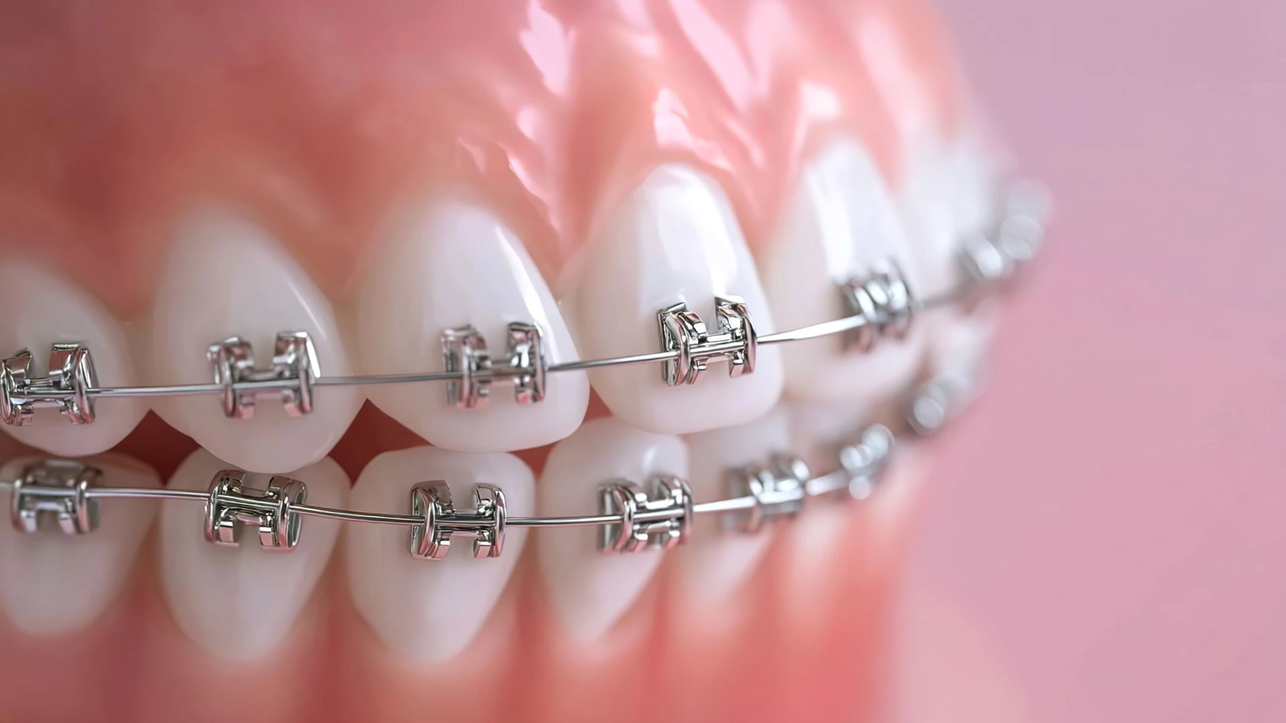 Răng hô có di truyền không? Giải thích khoa học và hướng can thiệp hiệu quả