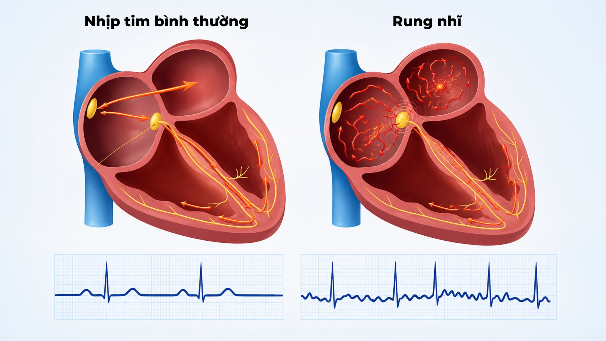 Rung nhĩ ở người trẻ tuổi: Nguyên nhân và dấu hiệu cần biết