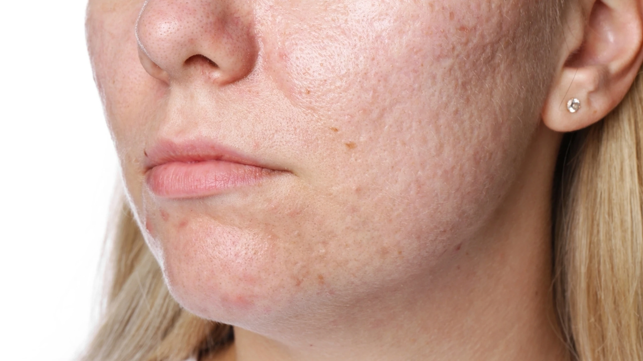 Sẹo rỗ nhẹ có hết không? Cách cải thiện đúng cách