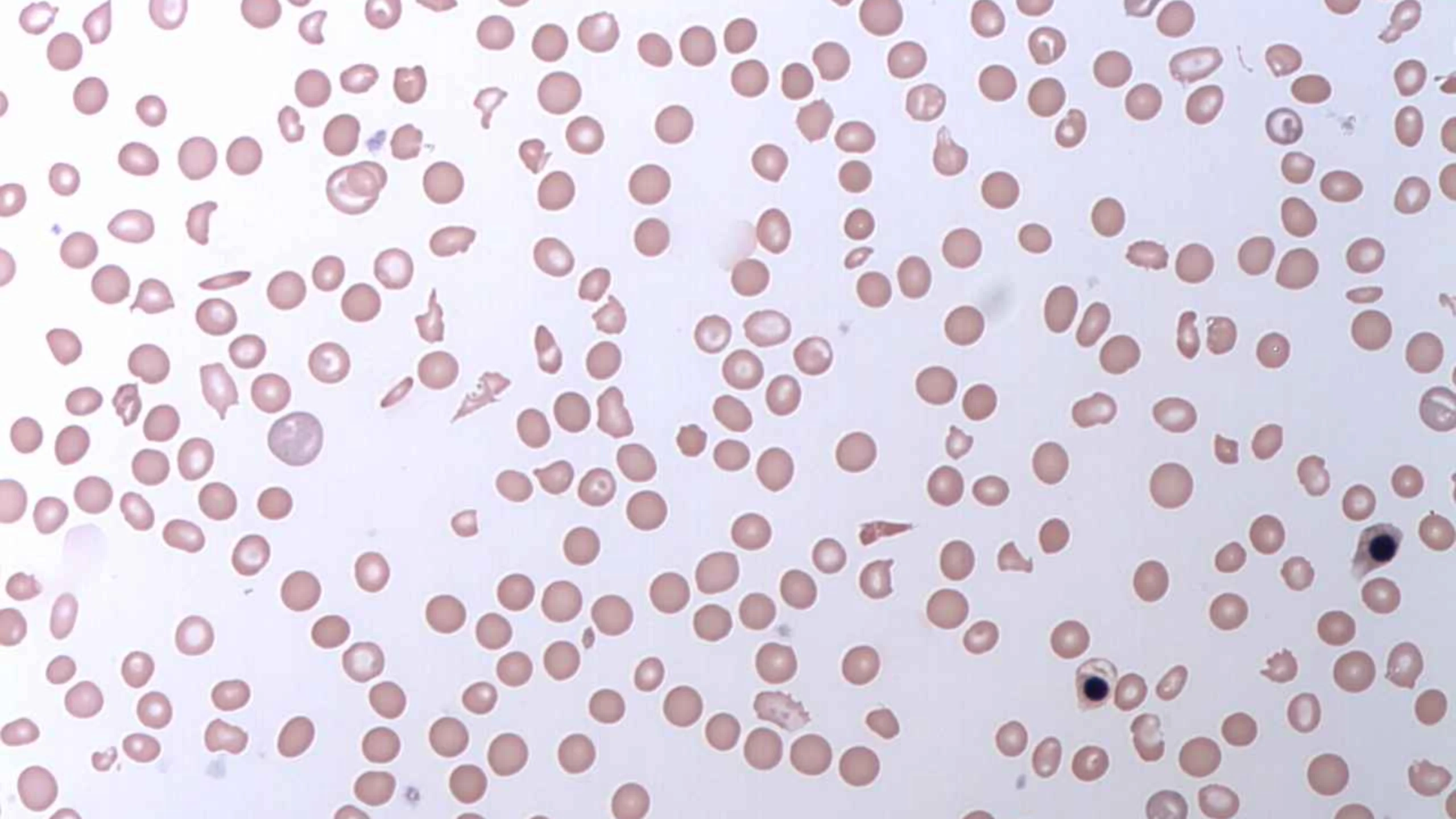 Soliris có tác dụng như thế nào đối với bệnh PNH? Hiệu quả điều trị